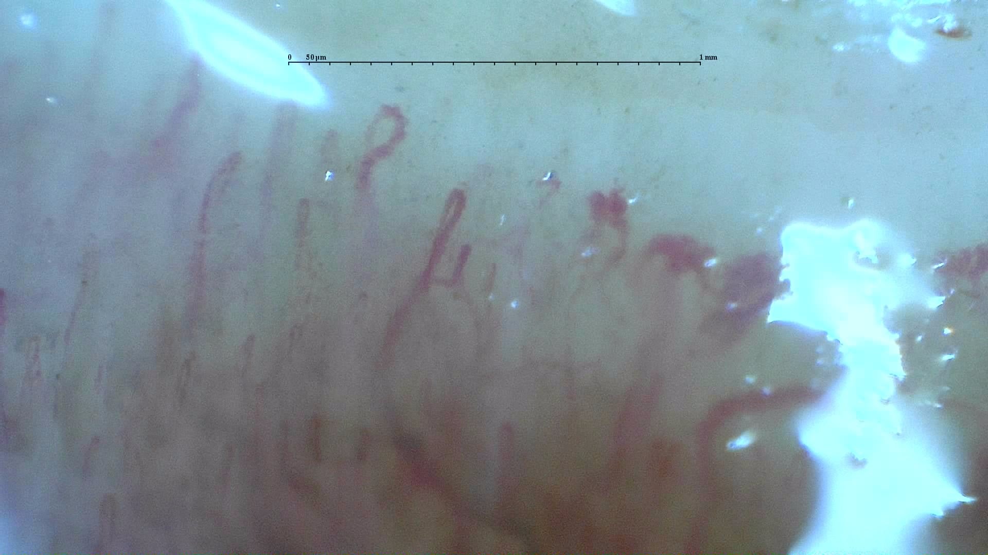 Nailfold capillaroscopy: left little finger, field c. Systemic Sclerosis with anti-U3 RNP: Late Microangiopathy.