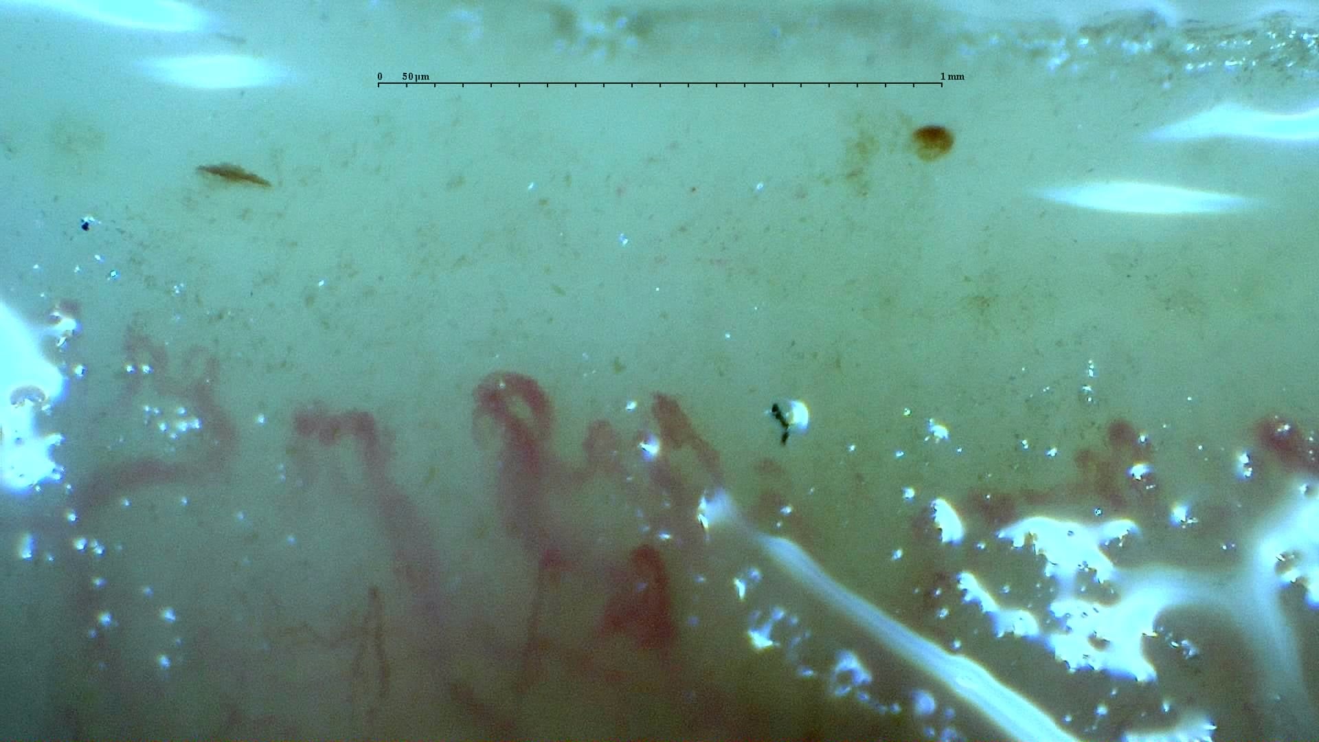 Nailfold capillaroscopy: right little finger, field b. Systemic Sclerosis with anti-U3 RNP: Late Microangiopathy.