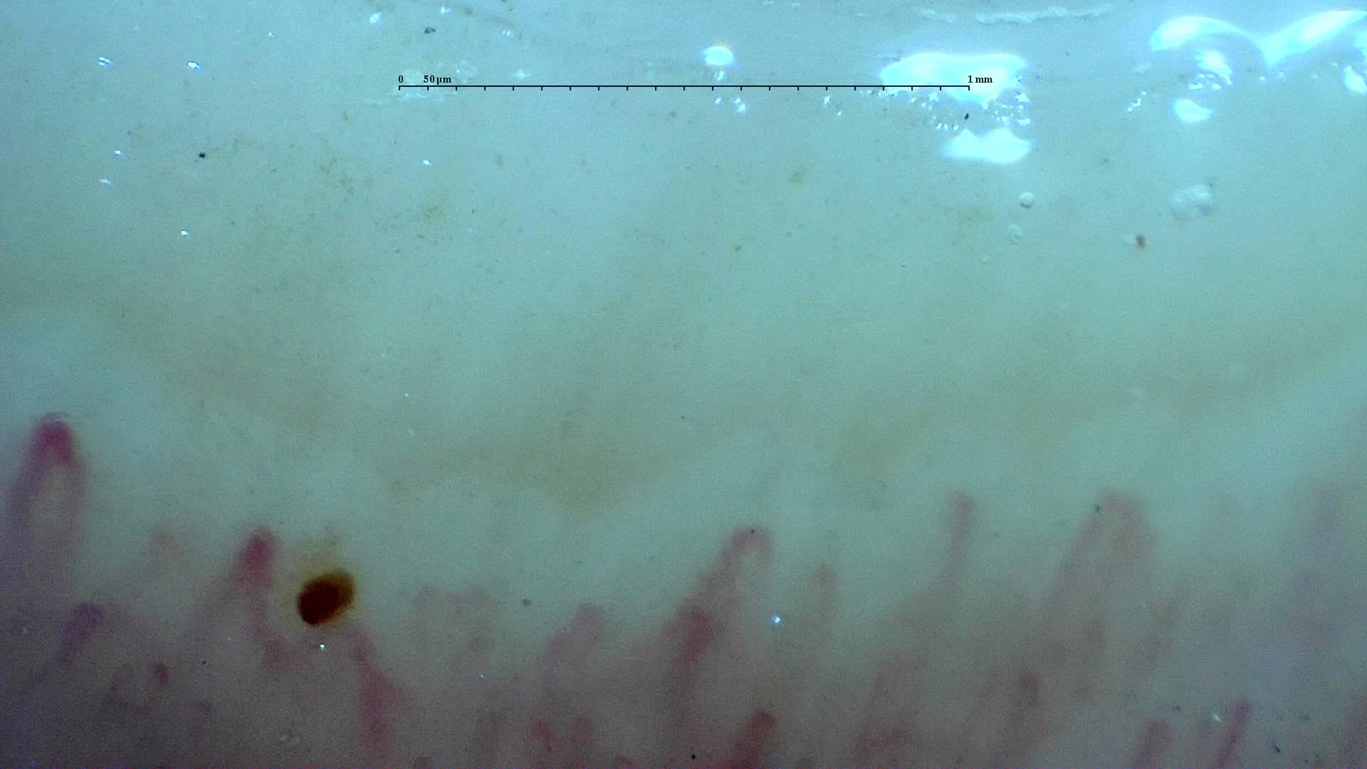 Nailfold capillaroscopy: left index finger, field a. Systemic Sclerosis with anti-U3 RNP: Late Microangiopathy.