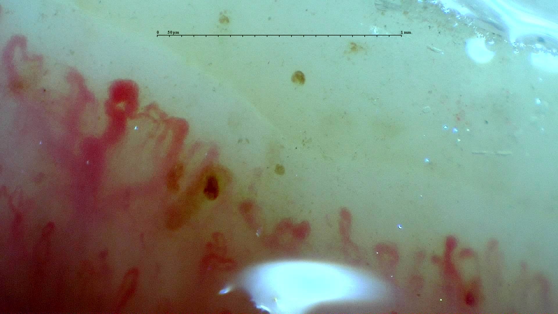 Nailfold capillaroscopy: left index finger, field c. Systemic Sclerosis with anti-U3 RNP: Late Microangiopathy.