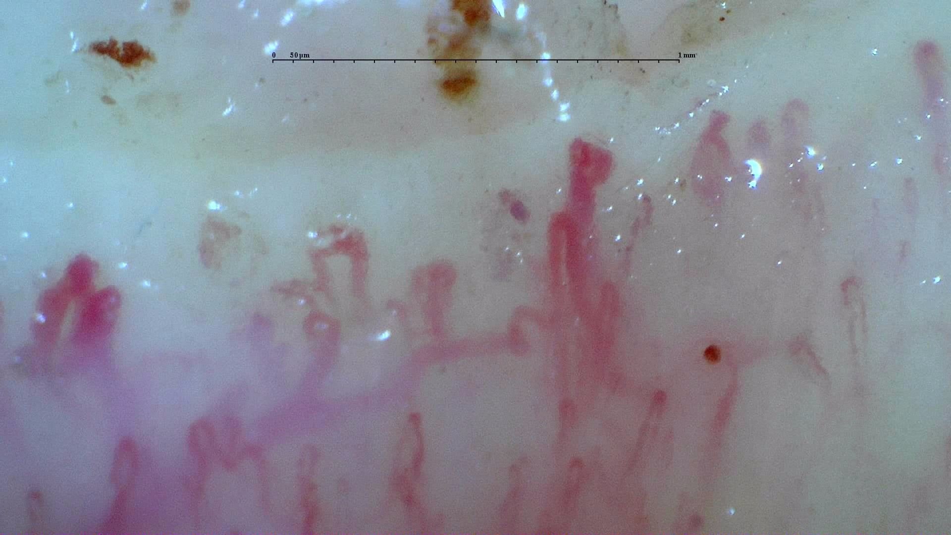 Nailfold capillaroscopy: right ring finger, field b. Systemic Sclerosis with anti-U3 RNP: Late Microangiopathy.