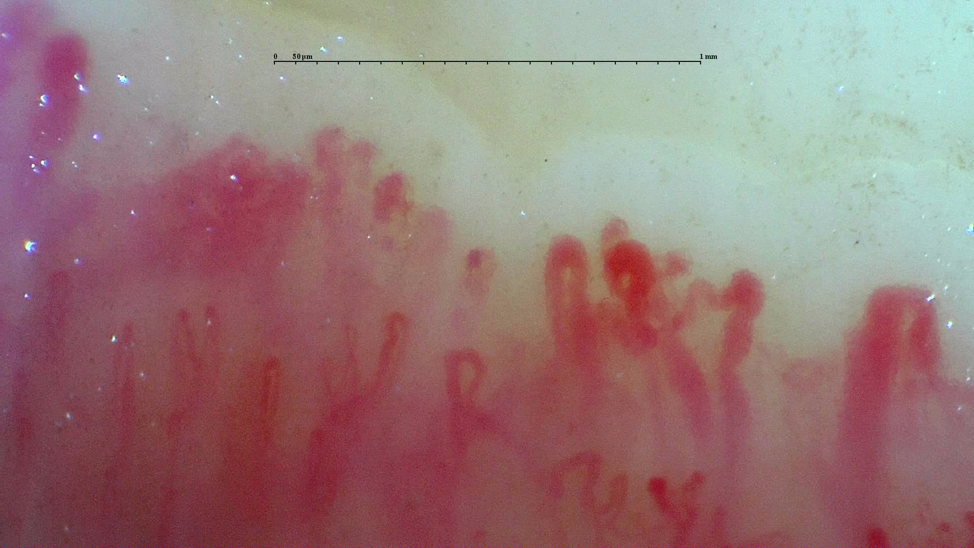 Nailfold capillaroscopy: right ring finger, field d. Systemic Sclerosis with anti-U3 RNP: Late Microangiopathy.