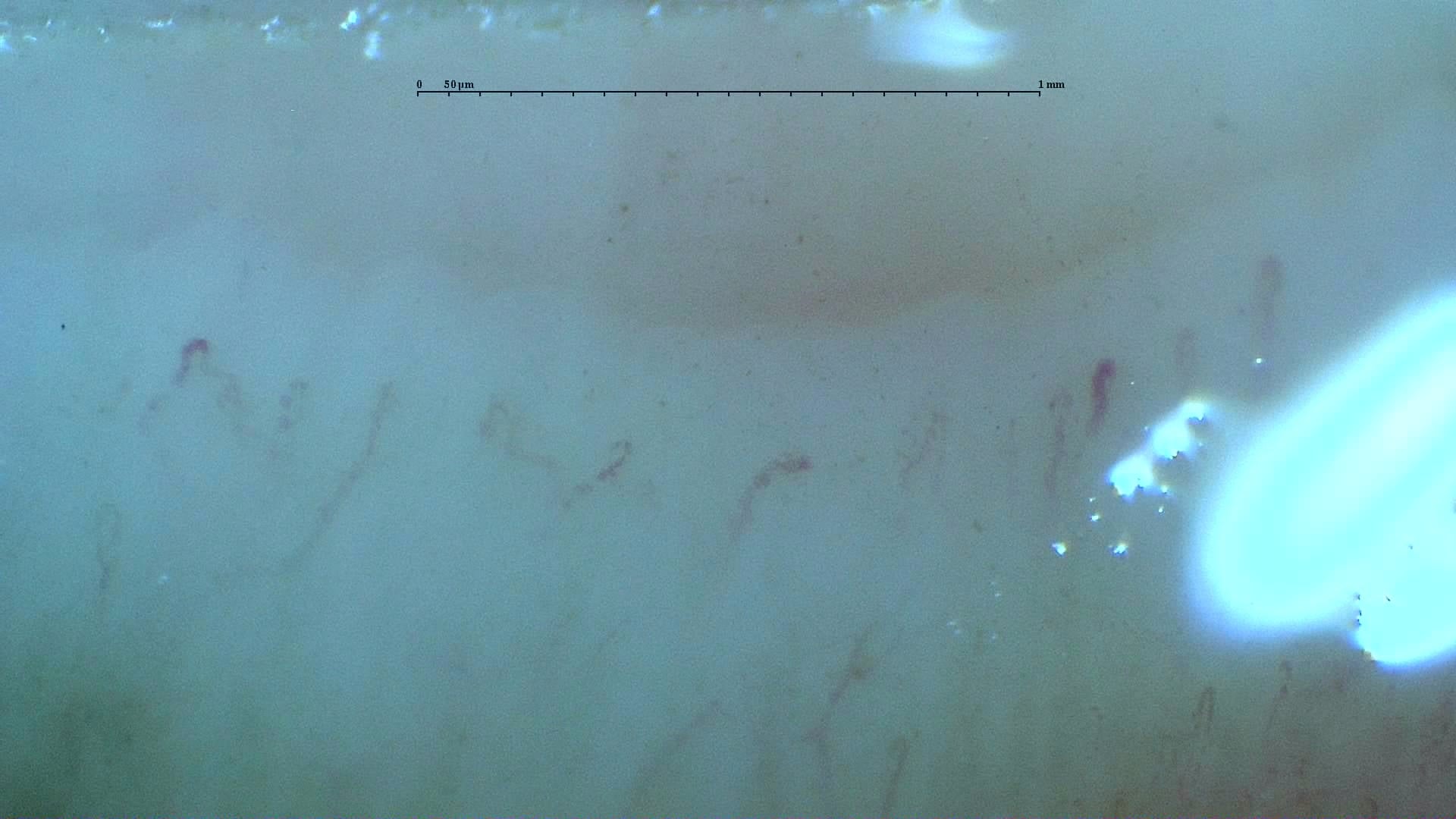 Nailfold capillaroscopy: right index finger, field a. Systemic Sclerosis with anti-U3 RNP: Late Microangiopathy.