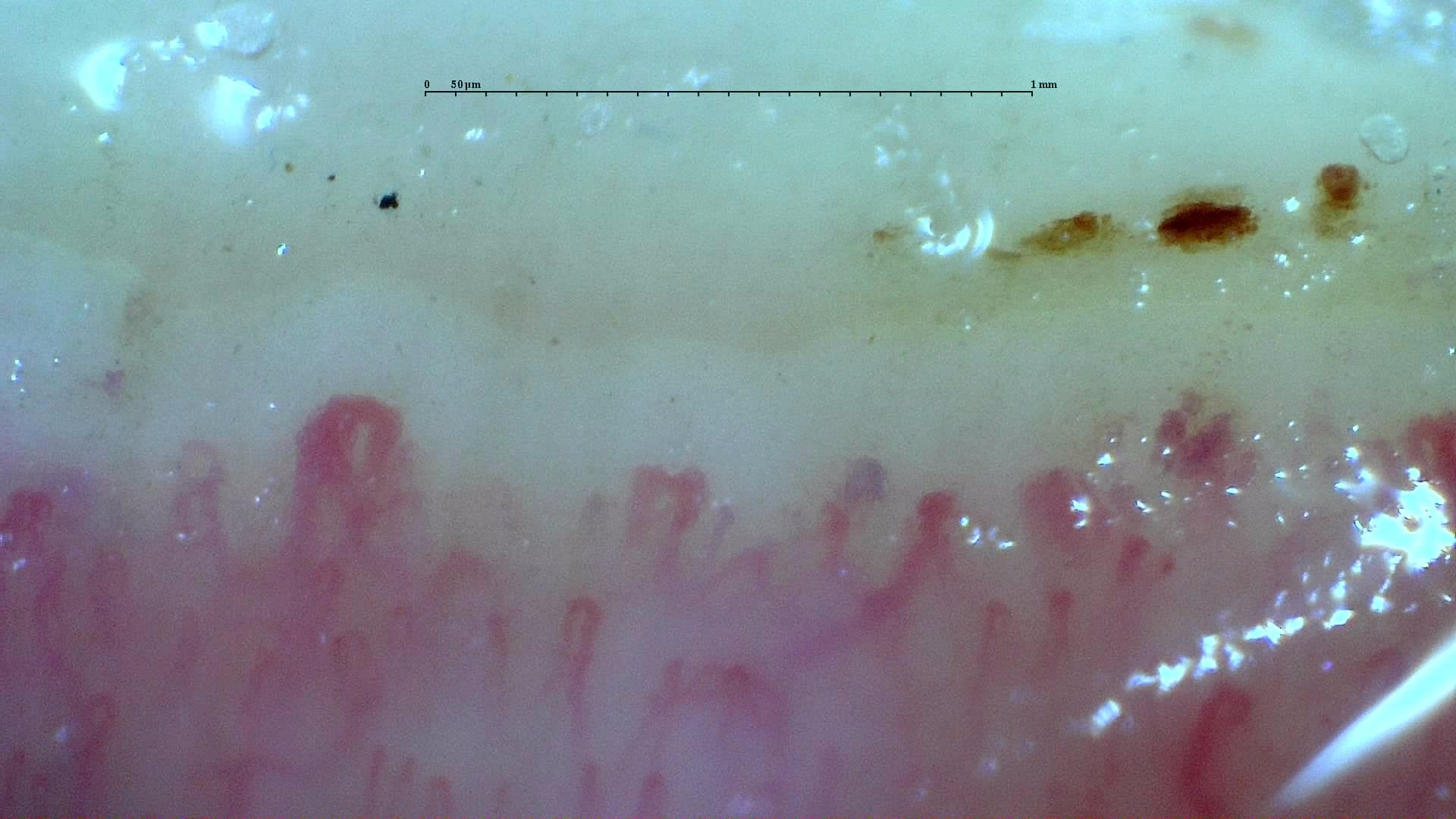 Nailfold capillaroscopy: right index finger, field c. Systemic Sclerosis with anti-U3 RNP: Late Microangiopathy.