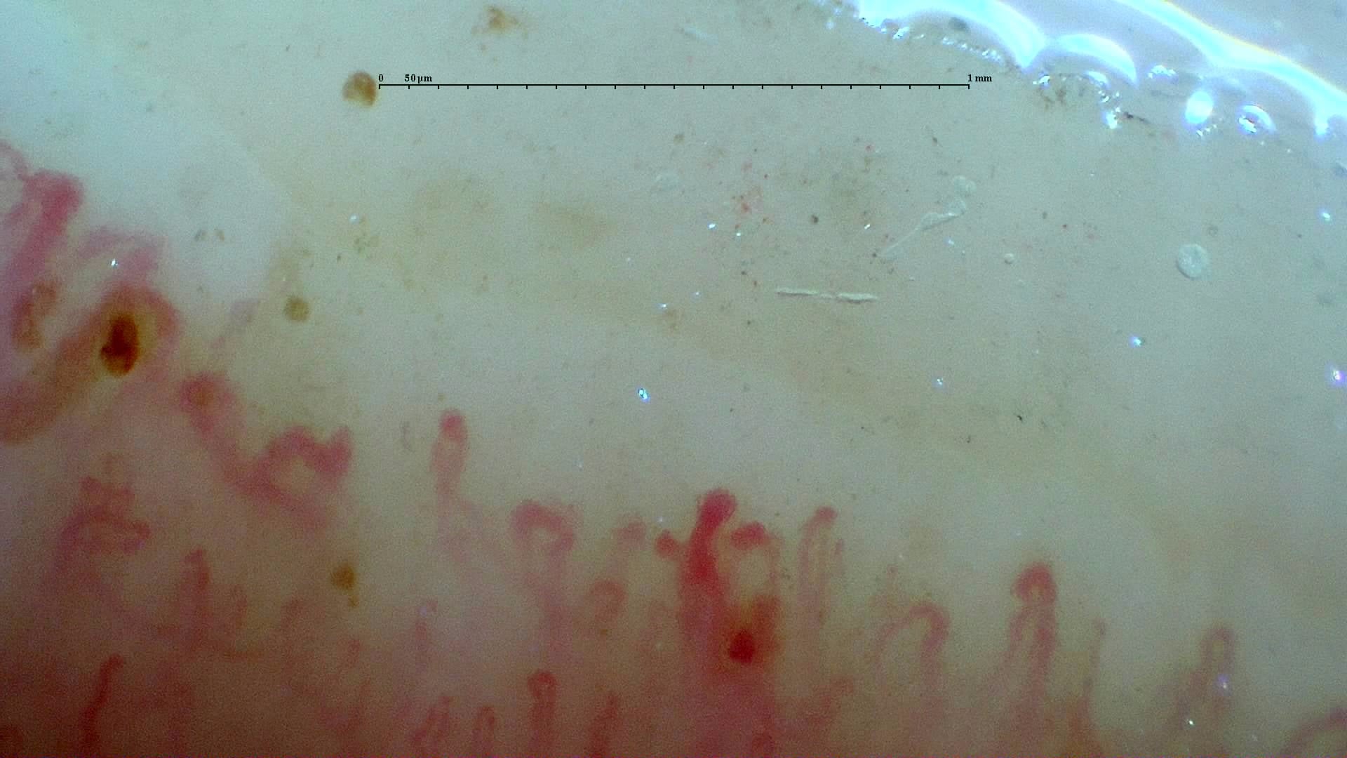 Nailfold capillaroscopy: left index finger, field b. Systemic Sclerosis with anti-U3 RNP: Late Microangiopathy.