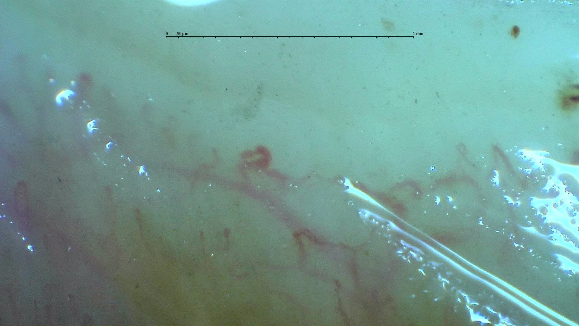 Nailfold capillaroscopy: right little finger, field d. Systemic Sclerosis with anti-U3 RNP: Late Microangiopathy.