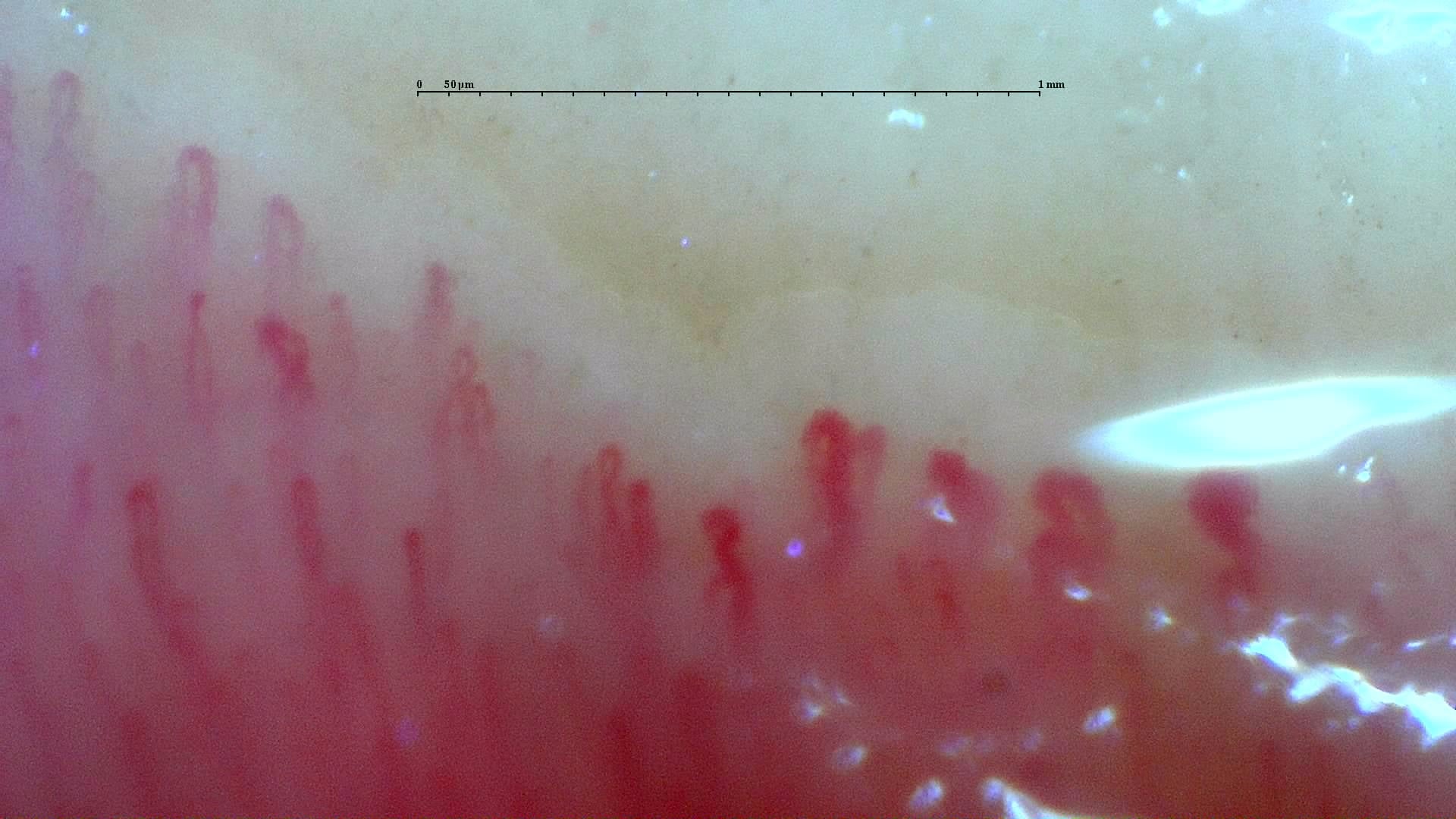 Nailfold capillaroscopy: right middle finger, field a. Systemic Sclerosis with anti-U3 RNP: Late Microangiopathy.