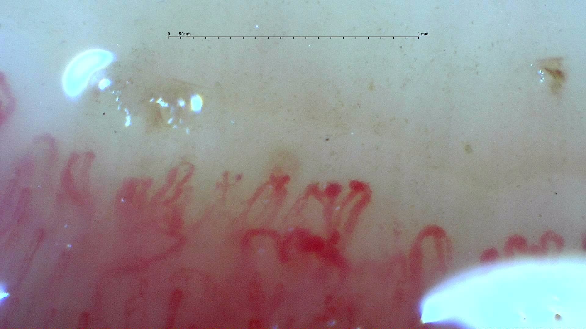 Nailfold capillaroscopy: left middle finger, field c. Systemic Sclerosis with anti-U3 RNP: Late Microangiopathy.