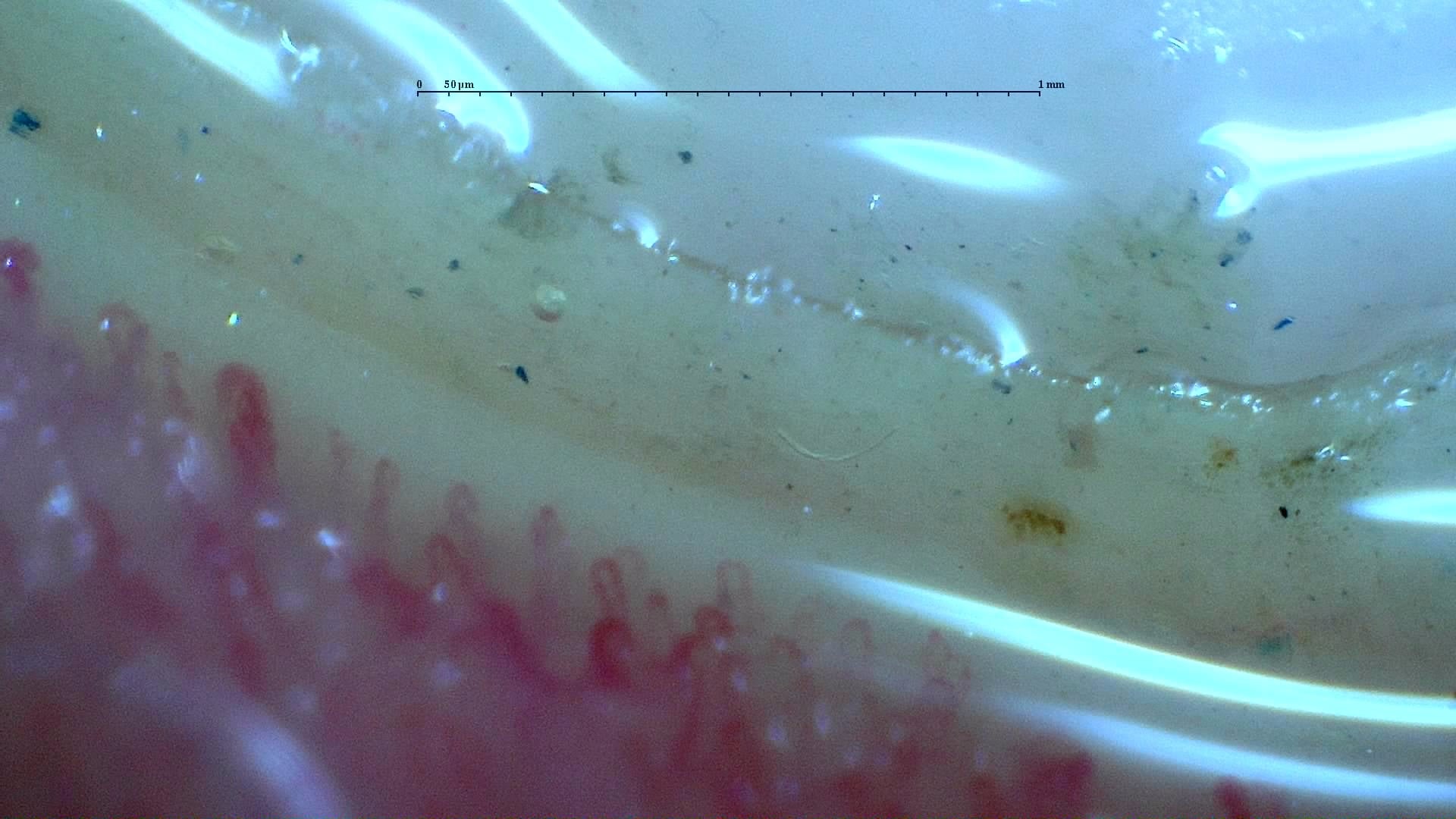 Nailfold capillaroscopy: right ring finger, field a. Systemic Sclerosis with anti-U3 RNP: Late Microangiopathy.