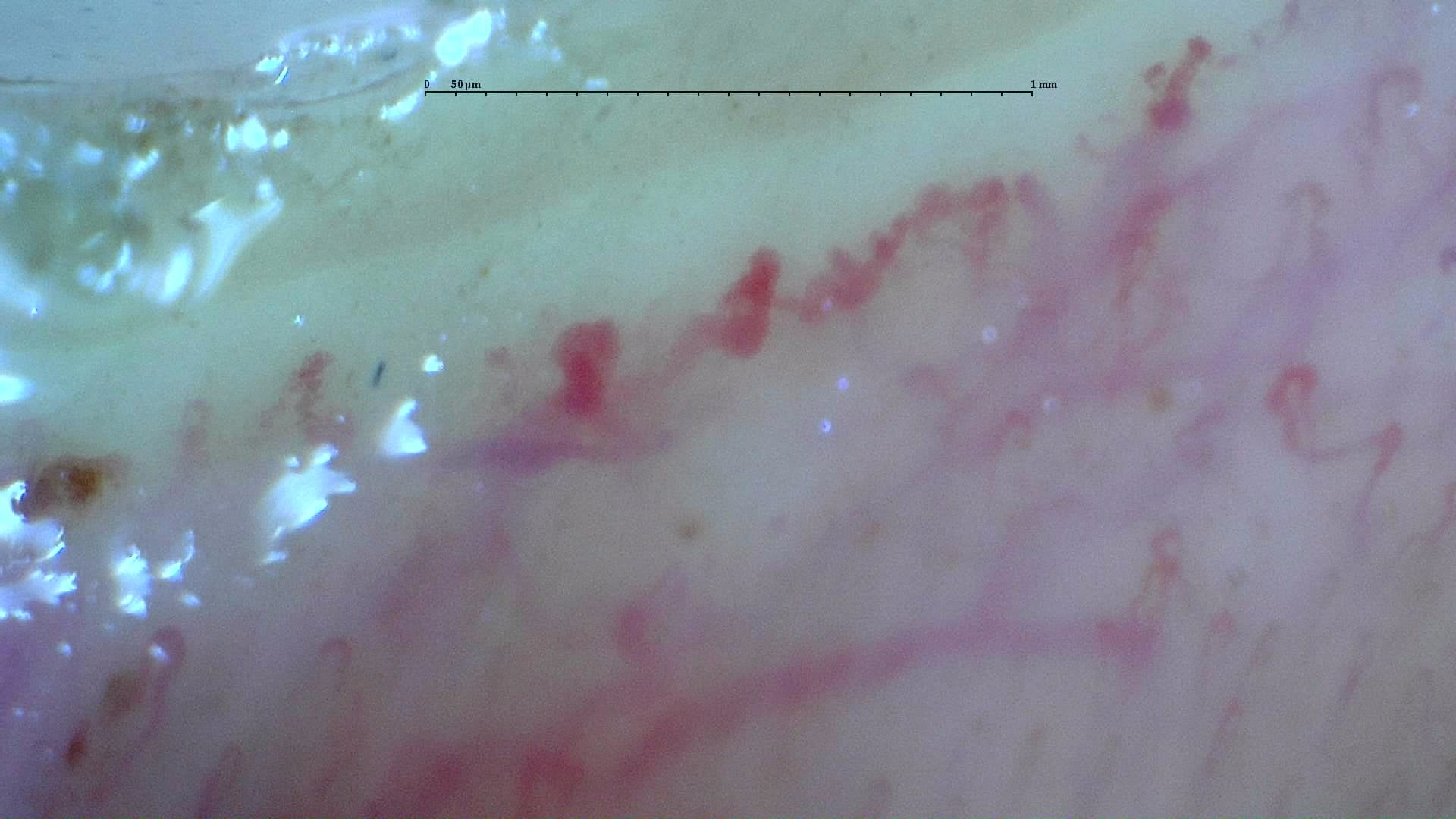 Nailfold capillaroscopy: right index finger, field b. Systemic Sclerosis with anti-U3 RNP: Late Microangiopathy.