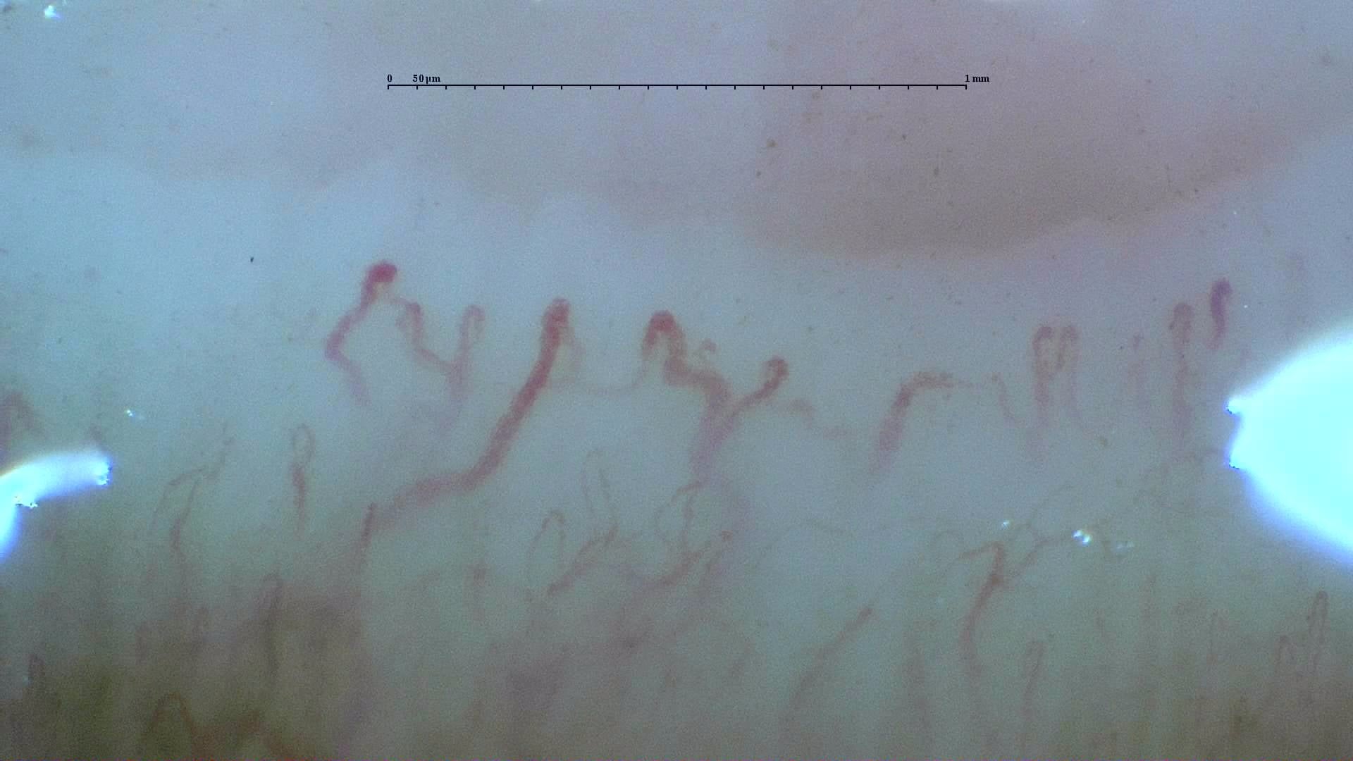 Nailfold capillaroscopy: left little finger, field a. Systemic Sclerosis with anti-U3 RNP: Late Microangiopathy.