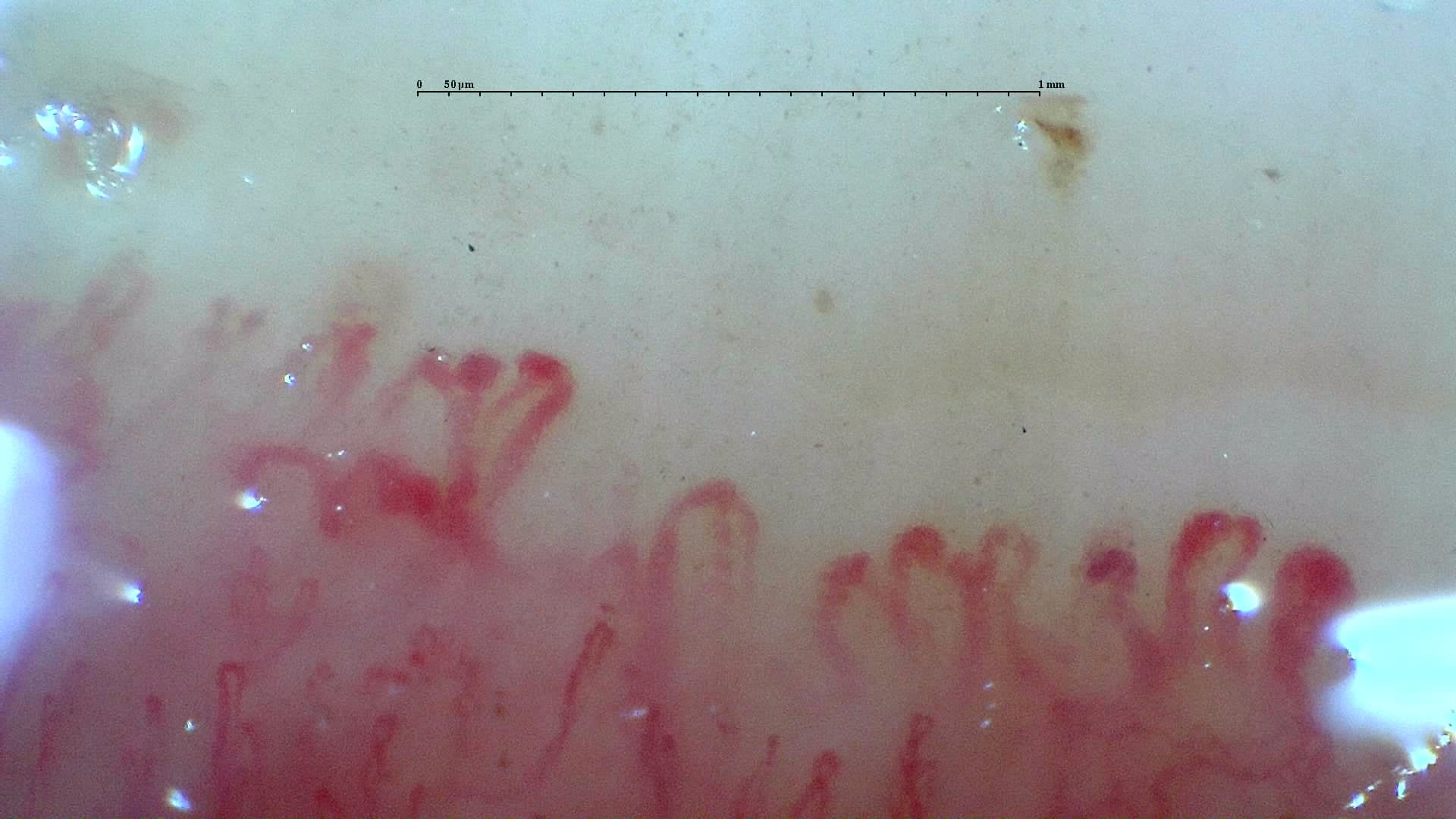 Nailfold capillaroscopy: left middle finger, field b. Systemic Sclerosis with anti-U3 RNP: Late Microangiopathy.