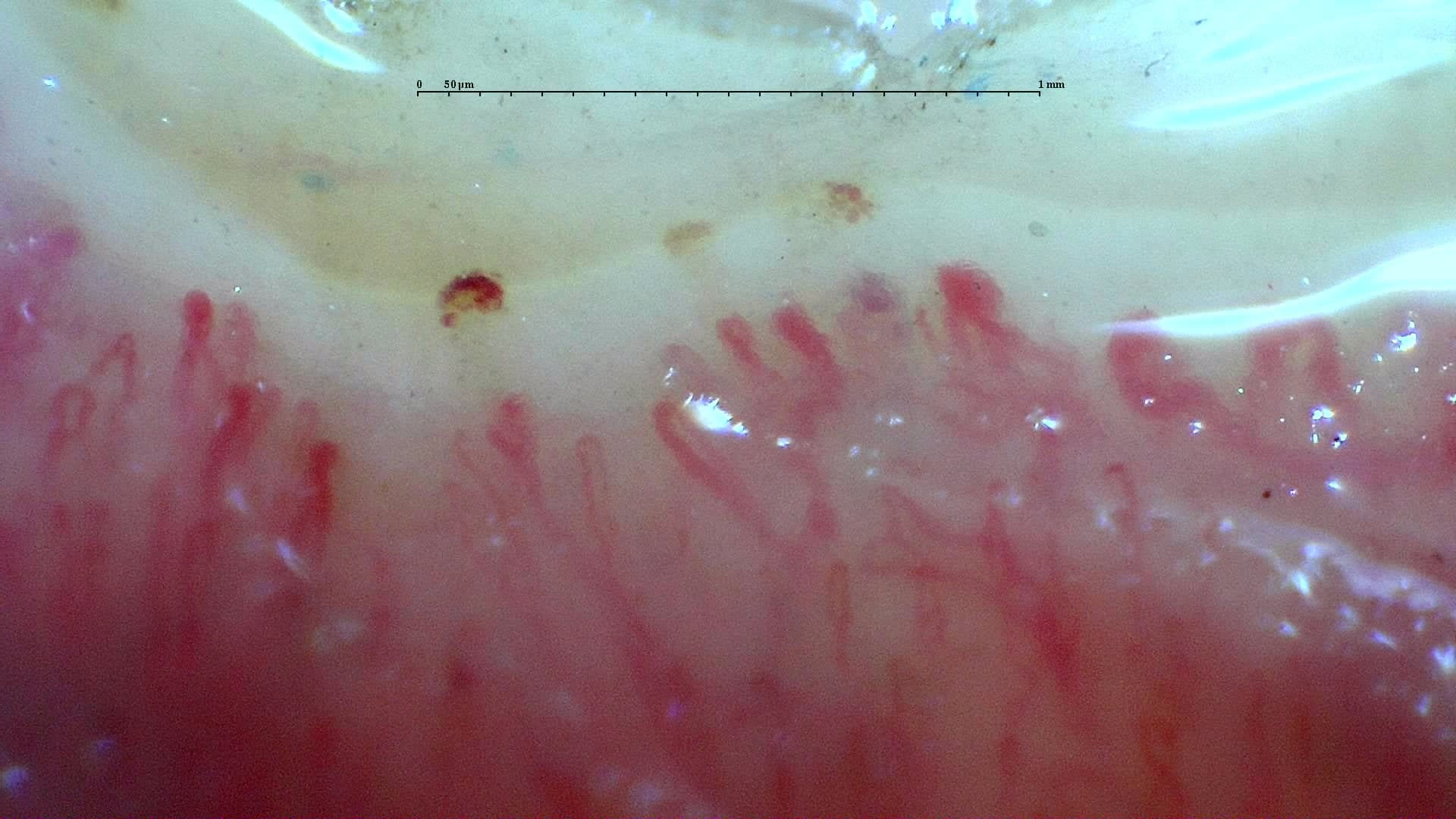 Nailfold capillaroscopy: right middle finger, field d. Systemic Sclerosis with anti-U3 RNP: Late Microangiopathy.