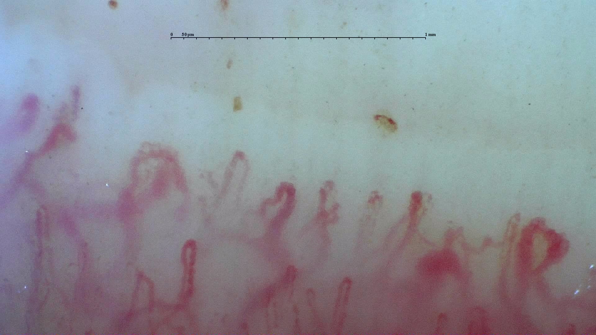 Nailfold capillaroscopy: left ring finger, field c. Systemic Sclerosis with anti-U3 RNP: Late Microangiopathy.