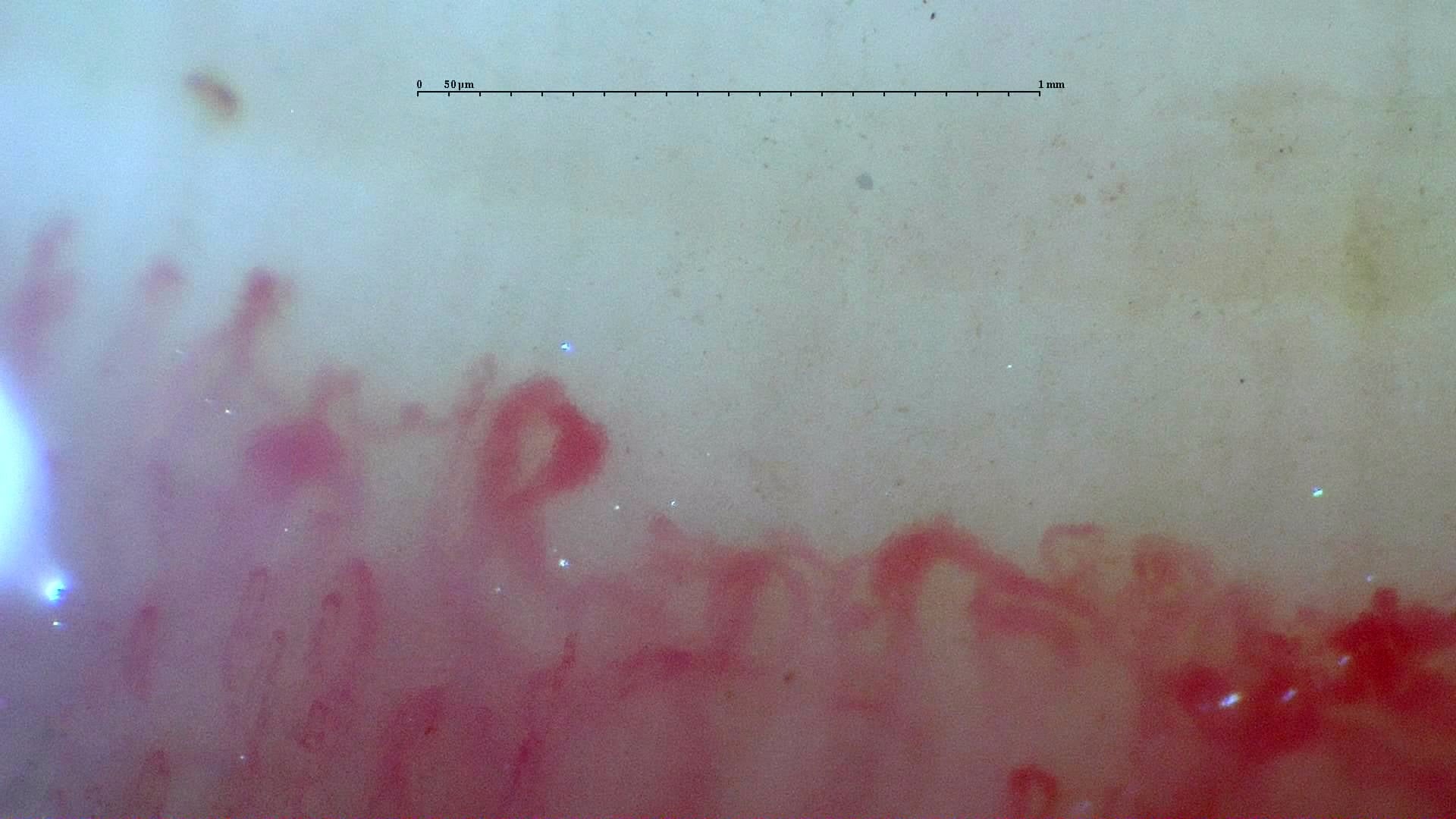 Nailfold capillaroscopy: left ring finger, field b. Systemic Sclerosis with anti-U3 RNP: Late Microangiopathy.
