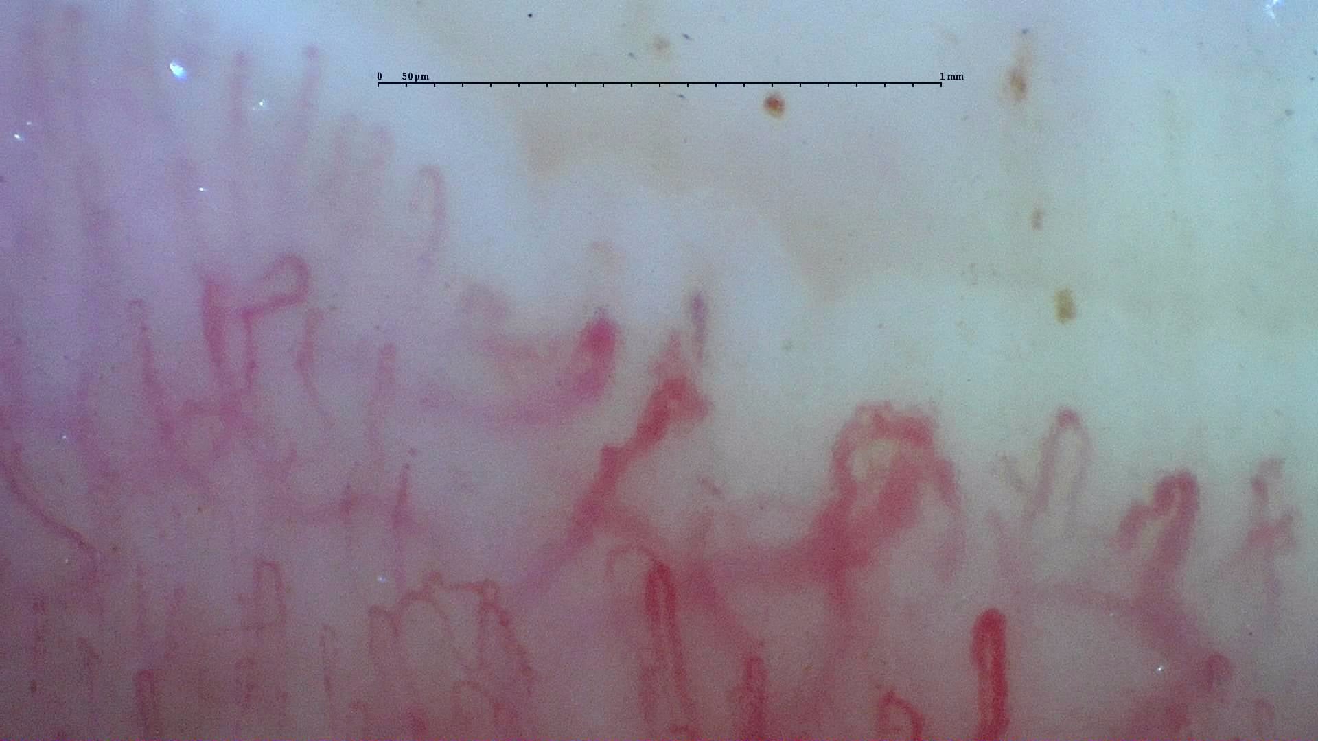 Nailfold capillaroscopy: left ring finger, field d. Systemic Sclerosis with anti-U3 RNP: Late Microangiopathy.