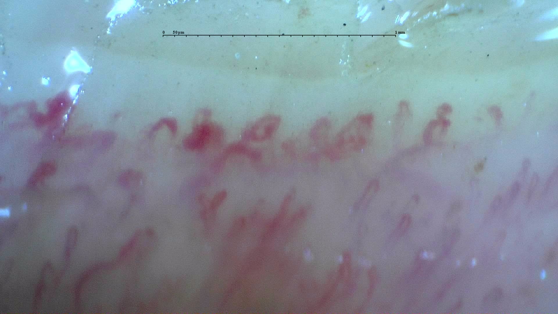 Nailfold capillaroscopy: left middle finger, field a. Systemic Sclerosis with anti-U3 RNP: Late Microangiopathy.