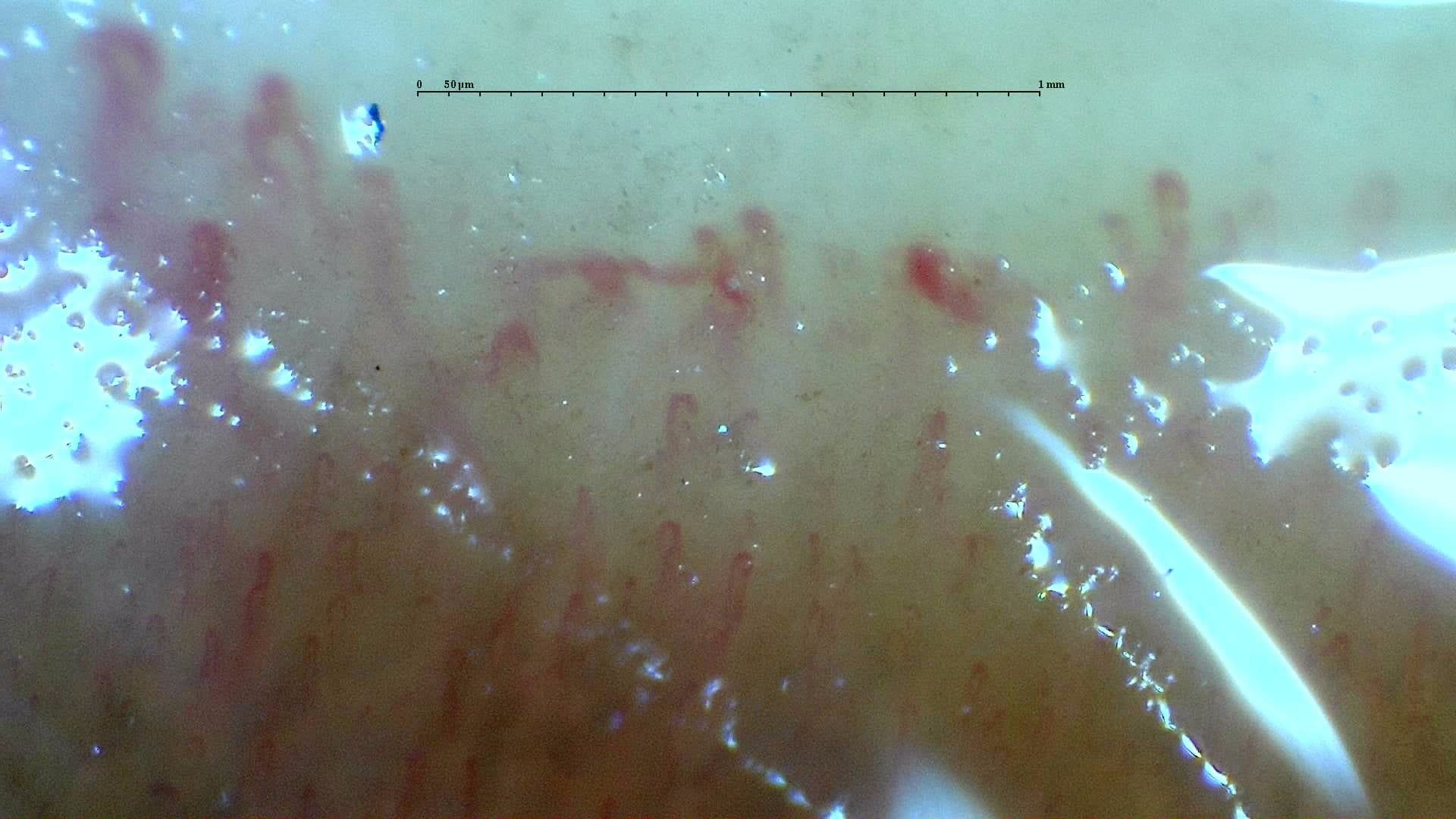 Nailfold capillaroscopy: right little finger, field a. Systemic Sclerosis with anti-U3 RNP: Late Microangiopathy.