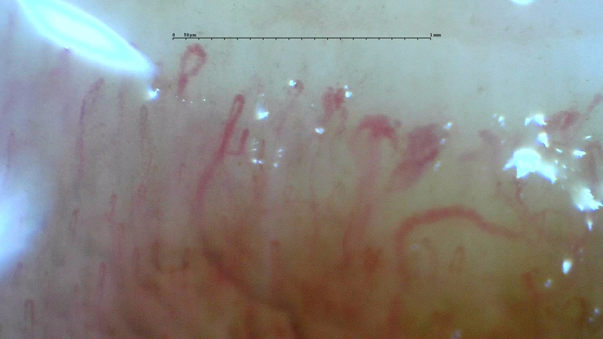 Nailfold capillaroscopy: left little finger, field b. Systemic Sclerosis with anti-U3 RNP: Late Microangiopathy.