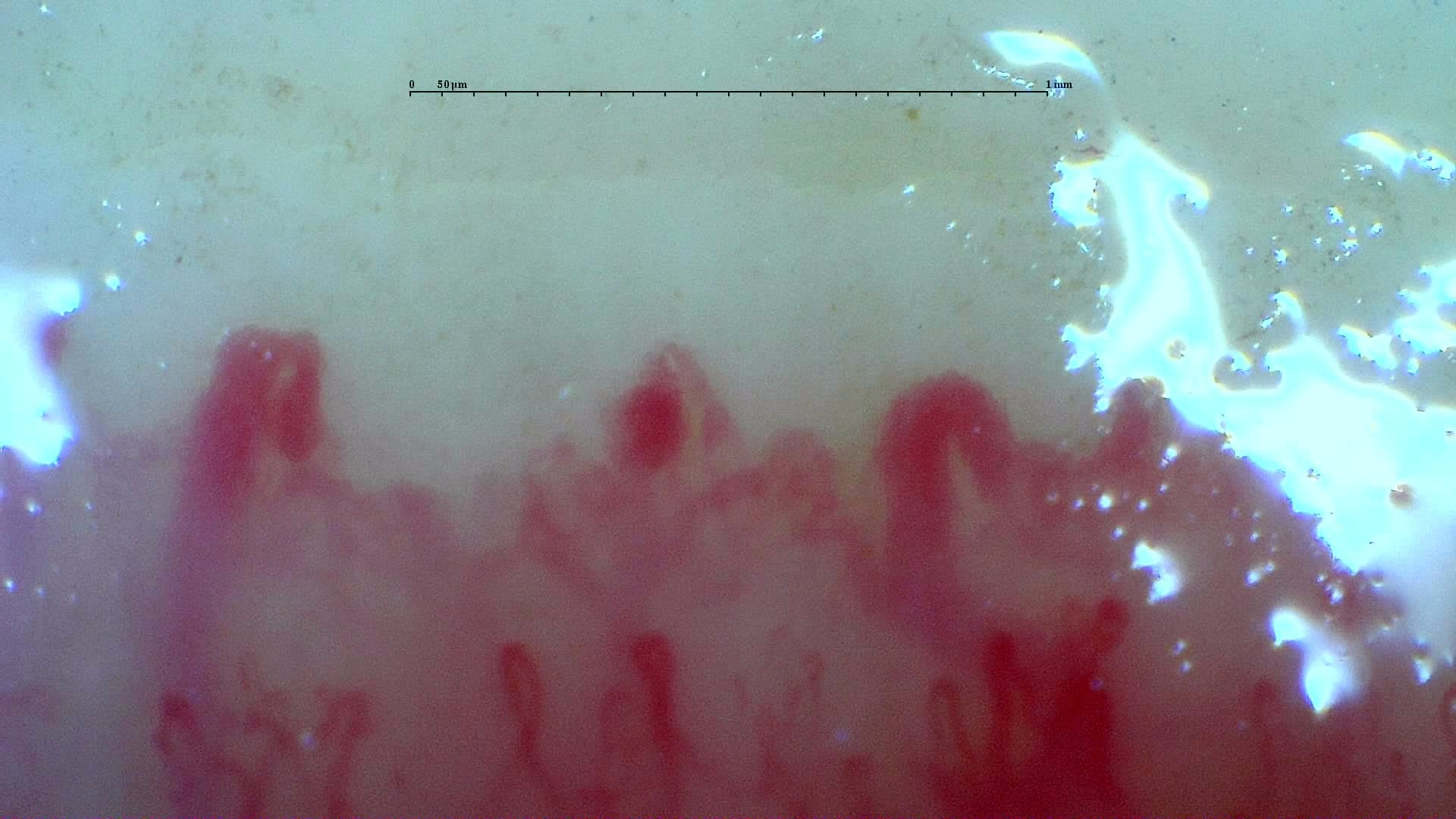Nailfold capillaroscopy: right ring finger, field c. Systemic Sclerosis with anti-U3 RNP: Late Microangiopathy.