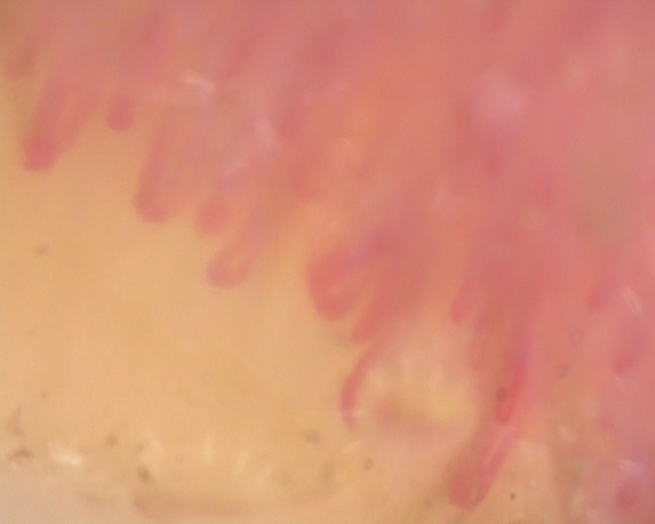 Nailfold capillaroscopy: right index finger, field a. Diffuse Systemic Sclerosis (Anti-Scl-70+) with Active Cutolo Pattern.