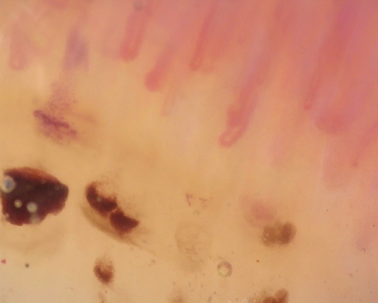 Nailfold capillaroscopy: right middle finger, field a. Diffuse Systemic Sclerosis (Anti-Scl-70+) with Active Cutolo Pattern.
