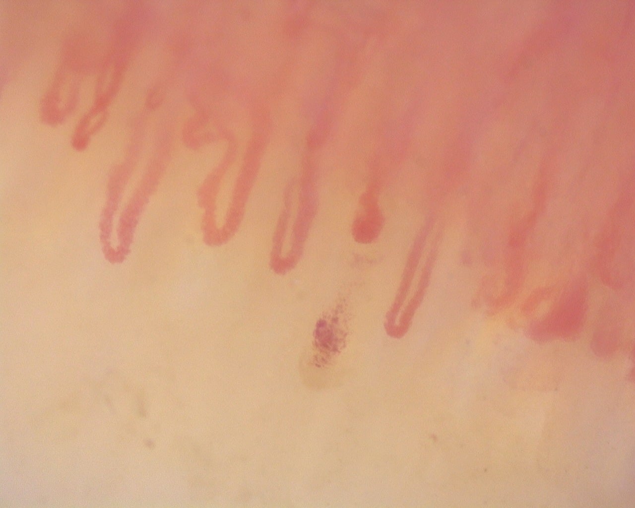 Nailfold capillaroscopy: right ring finger, field b. Diffuse Systemic Sclerosis (Anti-Scl-70+) with Active Cutolo Pattern.