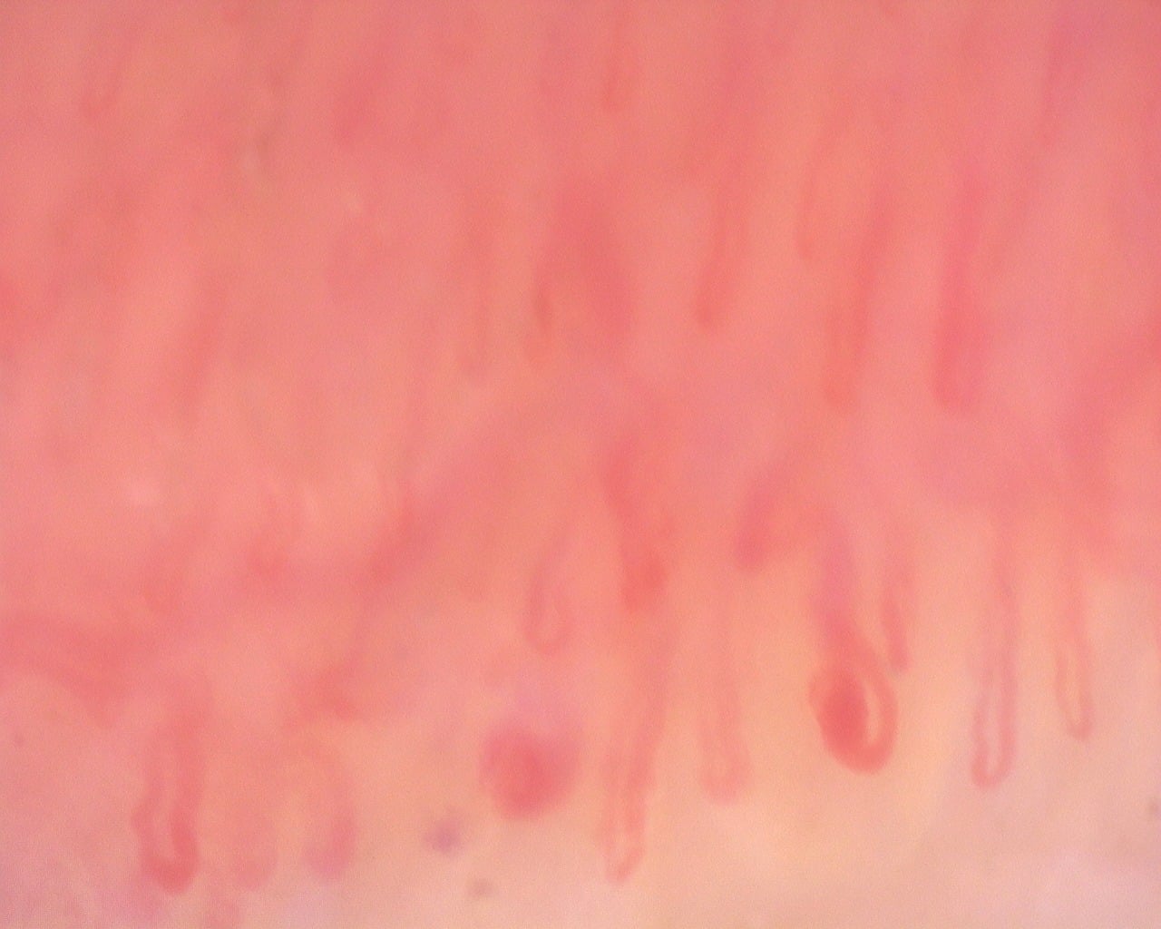 Nailfold capillaroscopy: right little finger, field d. Diffuse Systemic Sclerosis (Anti-Scl-70+) with Active Cutolo Pattern.