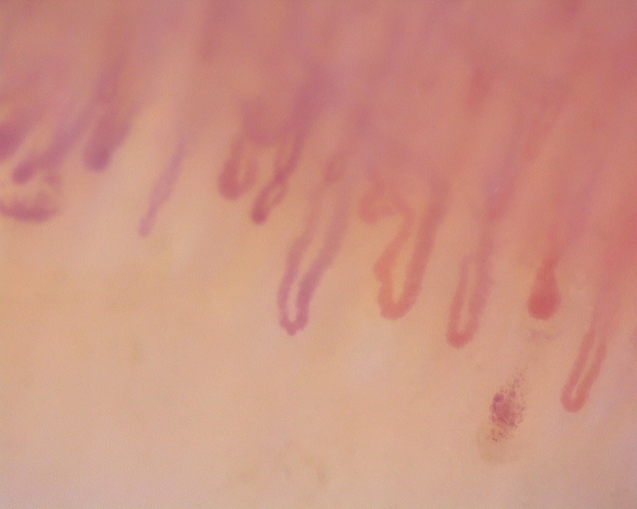 Nailfold capillaroscopy: right ring finger, field c. Diffuse Systemic Sclerosis (Anti-Scl-70+) with Active Cutolo Pattern.