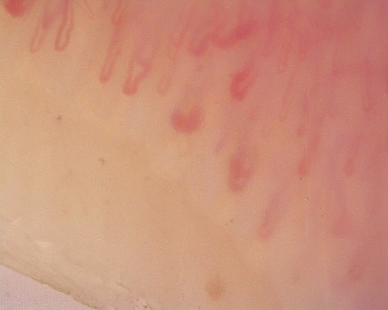 Nailfold capillaroscopy: right ring finger, field a. Diffuse Systemic Sclerosis (Anti-Scl-70+) with Active Cutolo Pattern.