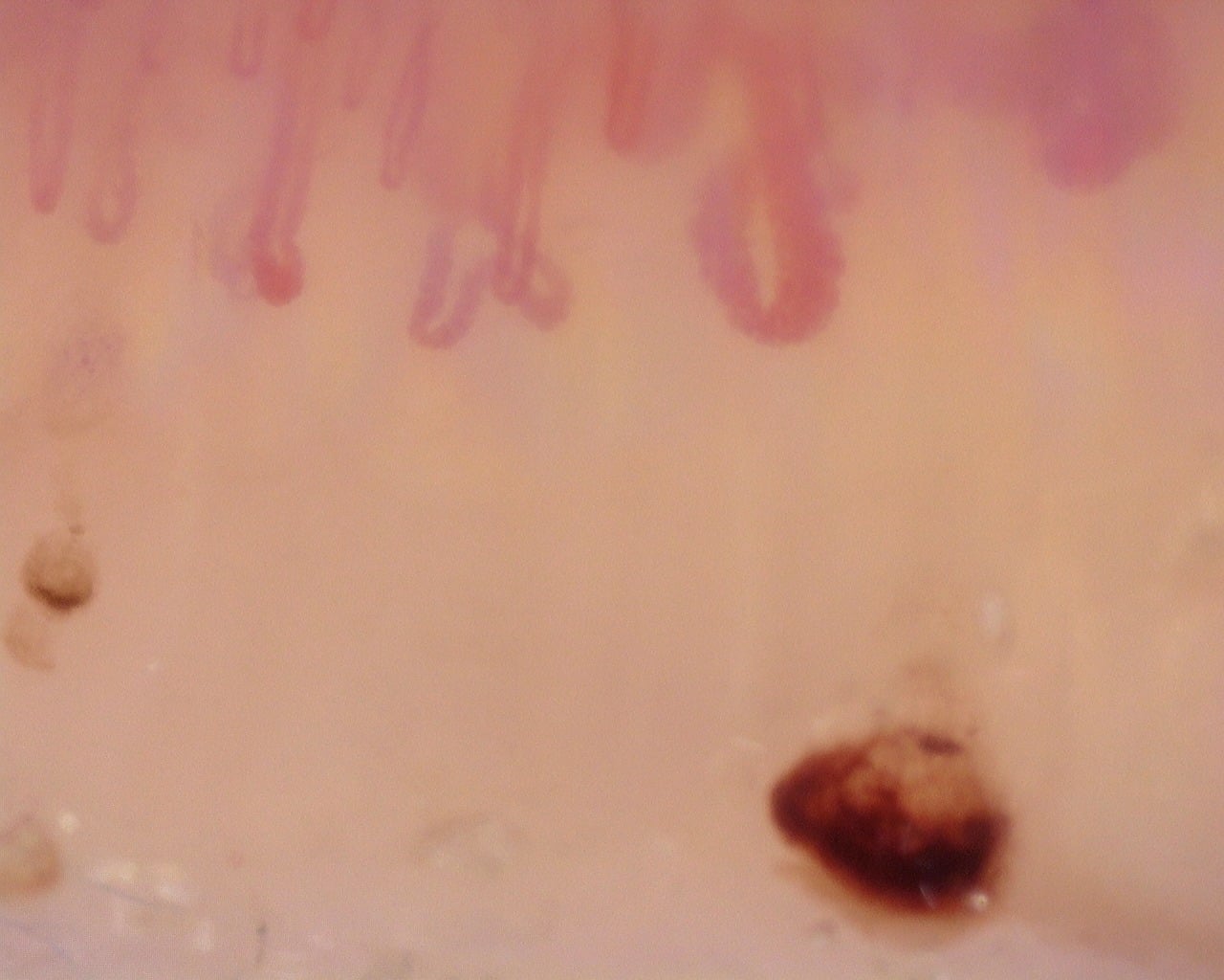 Nailfold capillaroscopy: left middle finger, field c. Diffuse Systemic Sclerosis (Anti-Scl-70+) with Active Cutolo Pattern.