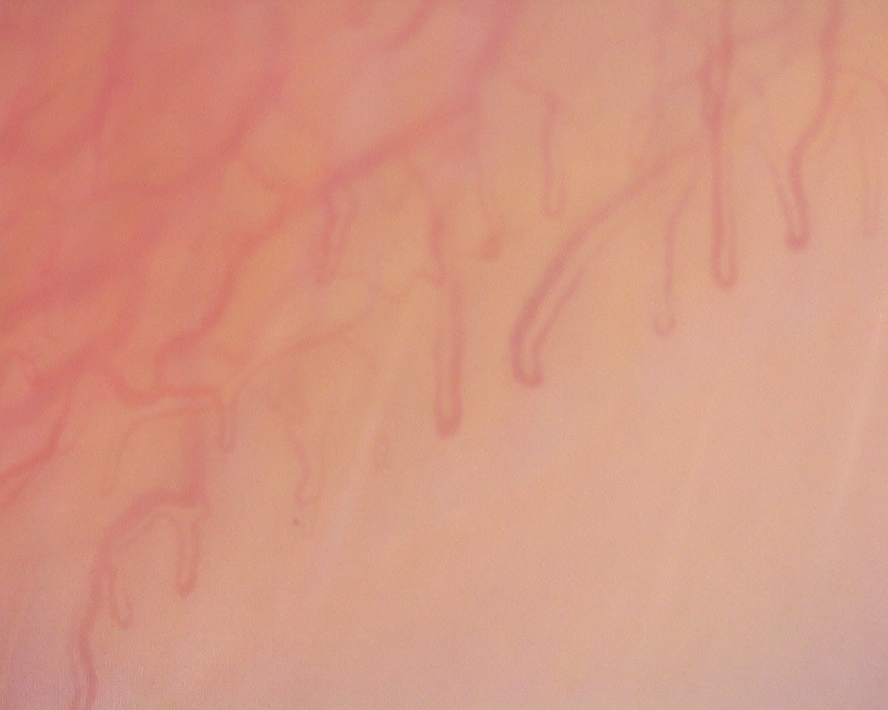 Nailfold capillaroscopy: left little finger, field a. Diffuse Systemic Sclerosis (Anti-Scl-70+) with Active Cutolo Pattern.