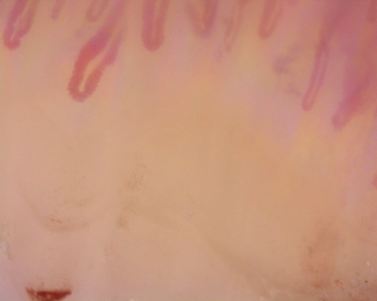 Nailfold capillaroscopy: left middle finger, field c. Diffuse Systemic Sclerosis (Anti-Scl-70+) with Active Cutolo Pattern.