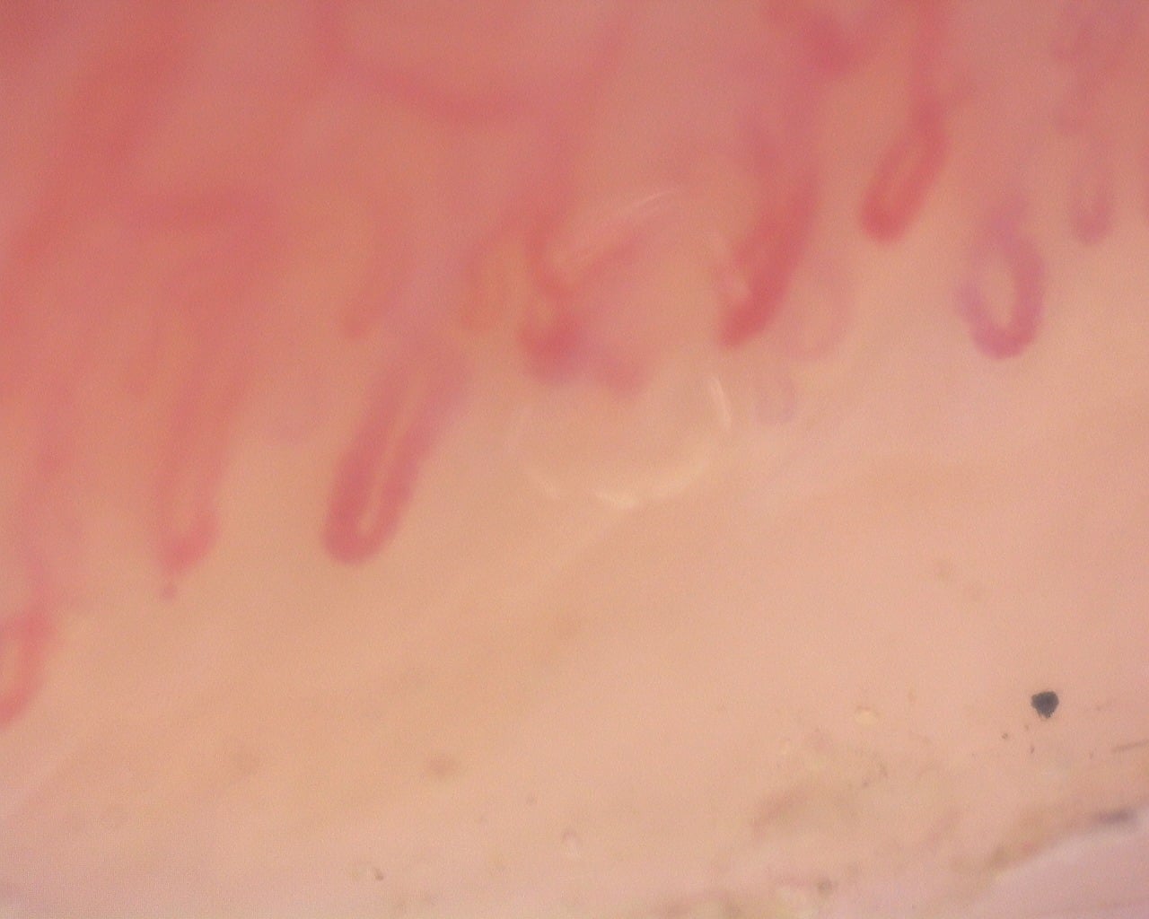 Nailfold capillaroscopy: left middle finger, field a. Diffuse Systemic Sclerosis (Anti-Scl-70+) with Active Cutolo Pattern.