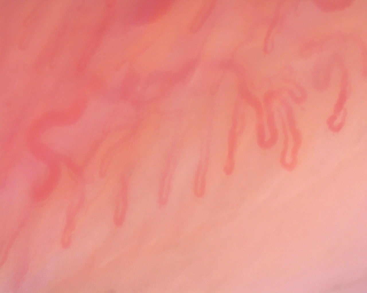Nailfold capillaroscopy: left ring finger, field a. Diffuse Systemic Sclerosis (Anti-Scl-70+) with Active Cutolo Pattern.
