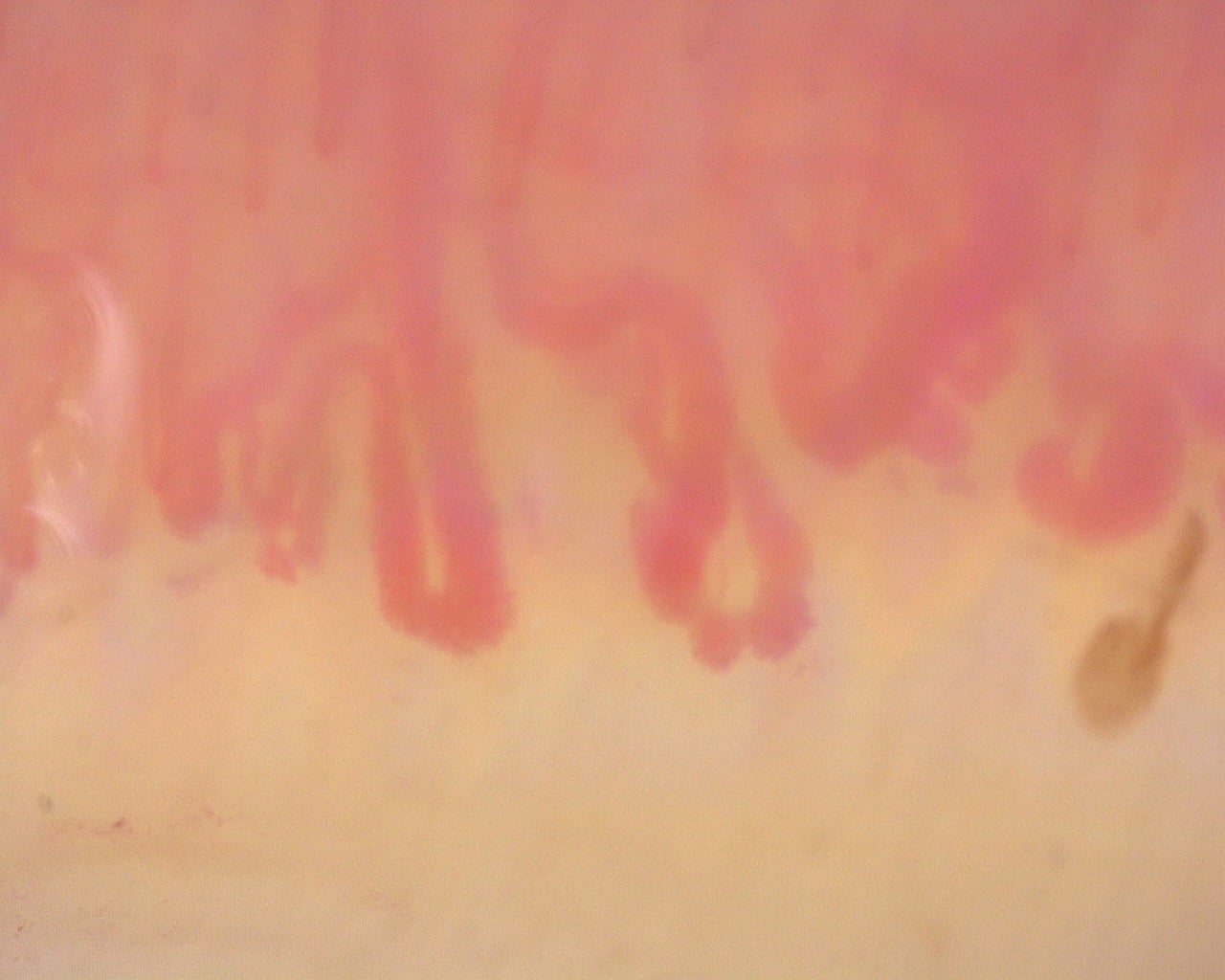 Nailfold capillaroscopy: right ring finger, field d. Diffuse Systemic Sclerosis (Anti-Scl-70+) with Active Cutolo Pattern.