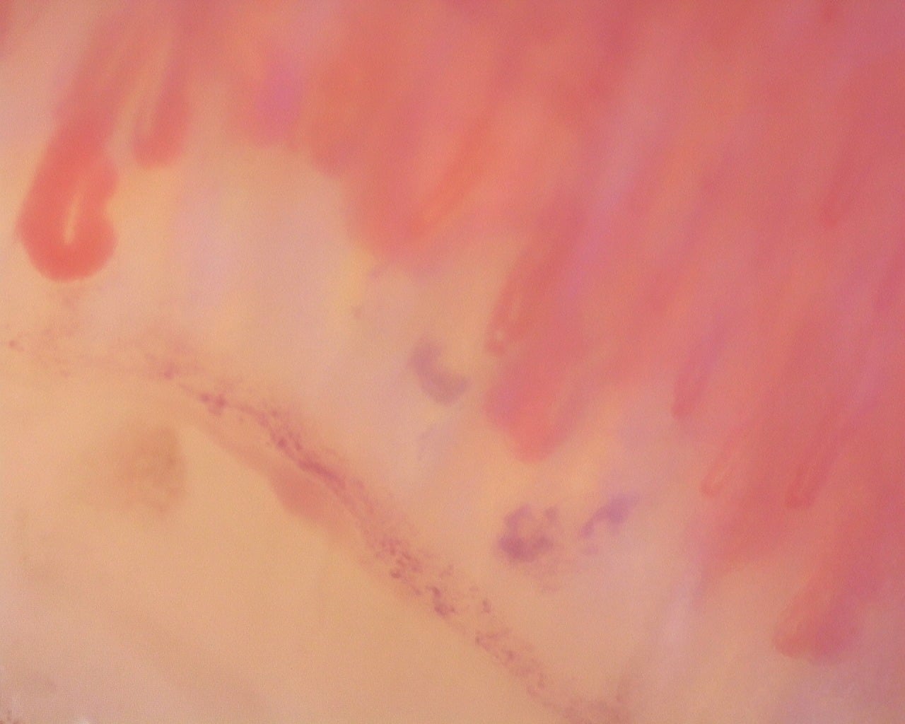 Nailfold capillaroscopy: left middle finger, field d. Diffuse Systemic Sclerosis (Anti-Scl-70+) with Active Cutolo Pattern.