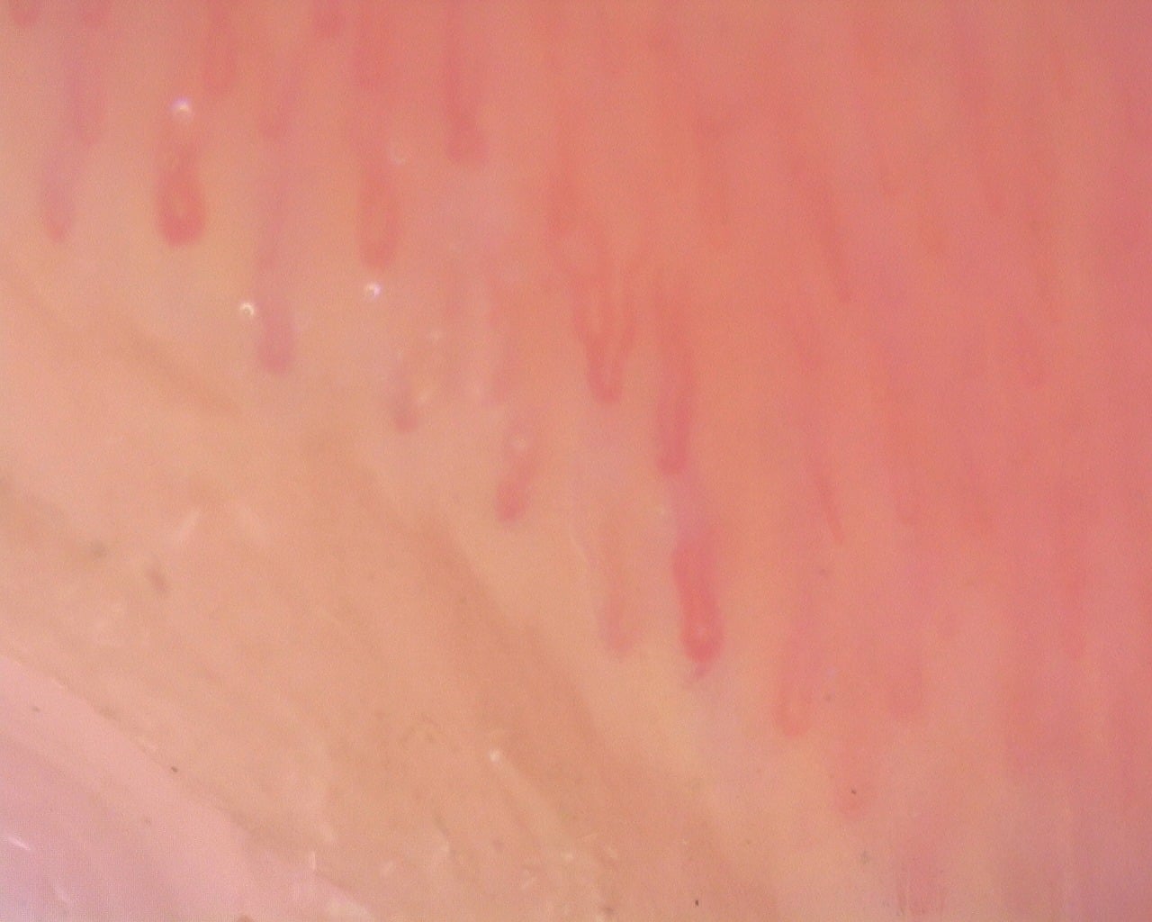 Nailfold capillaroscopy: right little finger, field a. Diffuse Systemic Sclerosis (Anti-Scl-70+) with Active Cutolo Pattern.