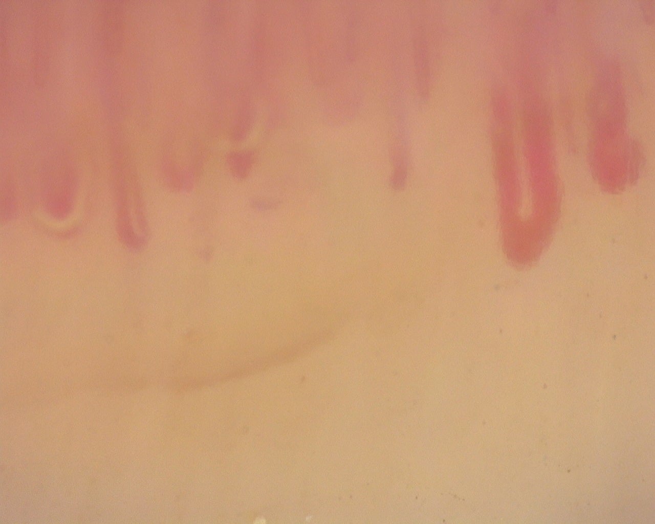 Nailfold capillaroscopy: right middle finger, field d. Diffuse Systemic Sclerosis (Anti-Scl-70+) with Active Cutolo Pattern.