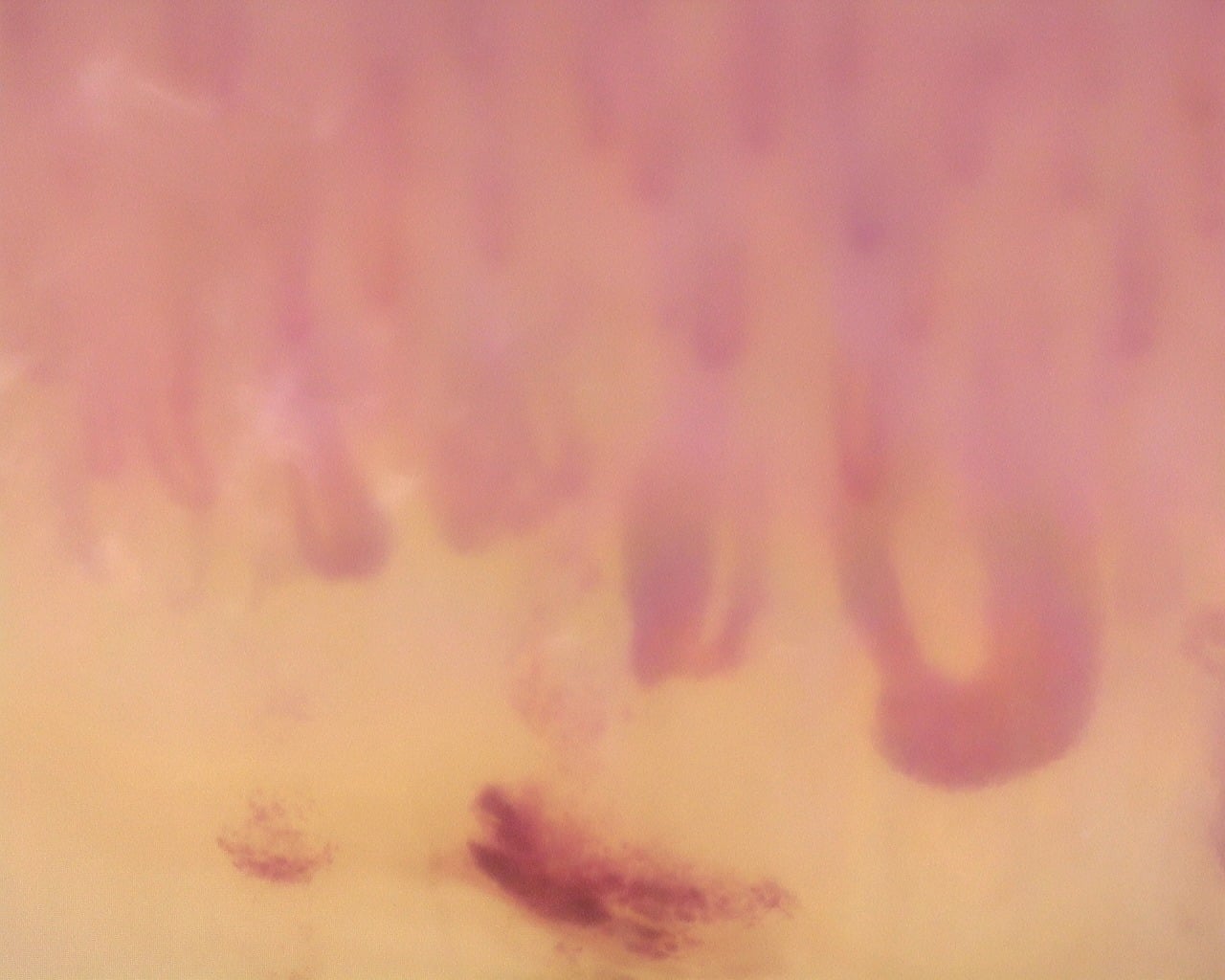 Nailfold capillaroscopy: right index finger, field b. Diffuse Systemic Sclerosis (Anti-Scl-70+) with Active Cutolo Pattern.