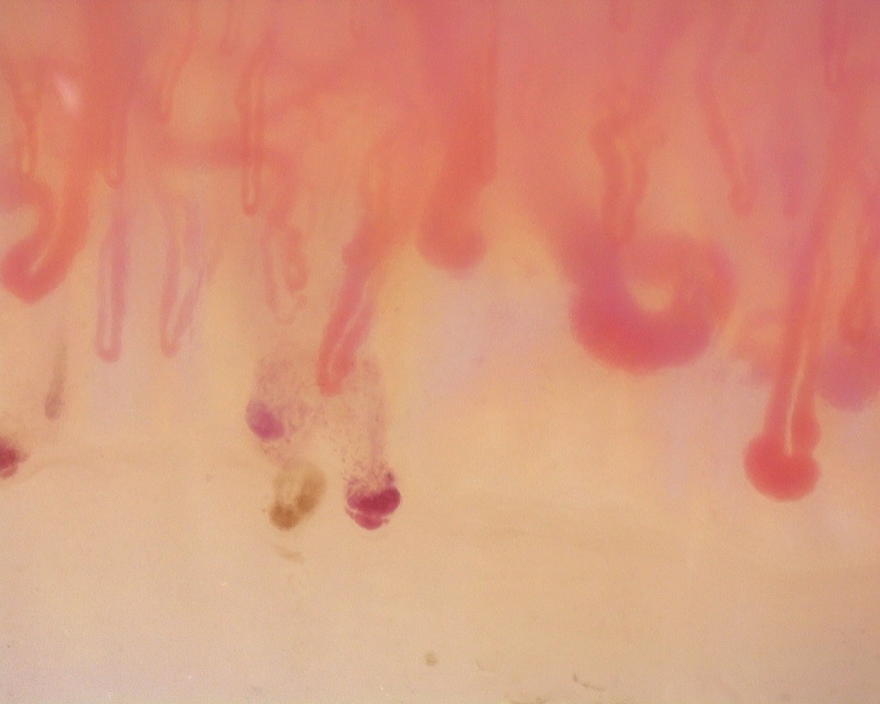 Enlarged loops and dark hemorrhagic deposits in the anti-Scl-70-positive active-pattern case. The source report notes no avascular areas in the study.