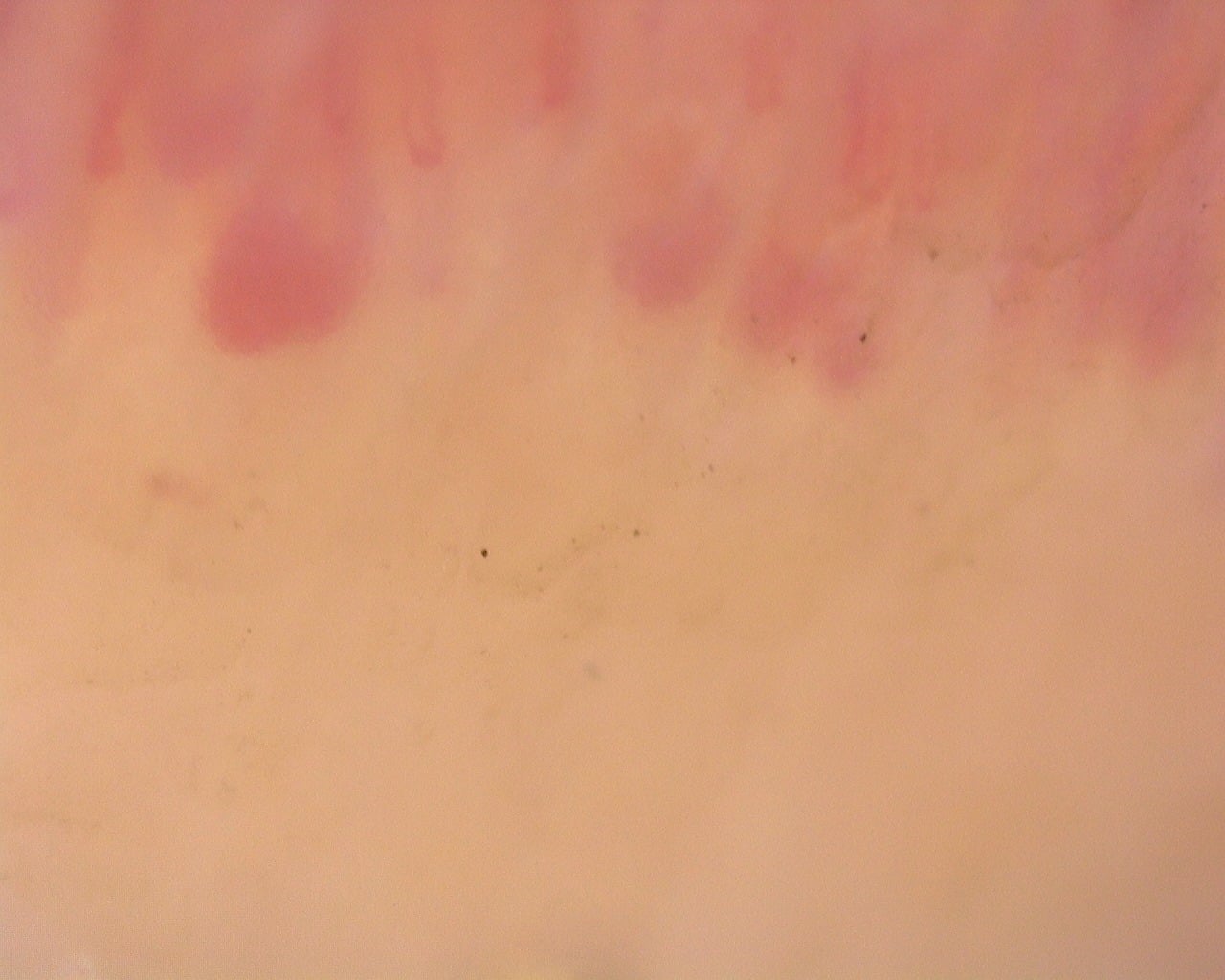 Nailfold capillaroscopy: right index finger, field d. Diffuse Systemic Sclerosis (Anti-Scl-70+) with Active Cutolo Pattern.