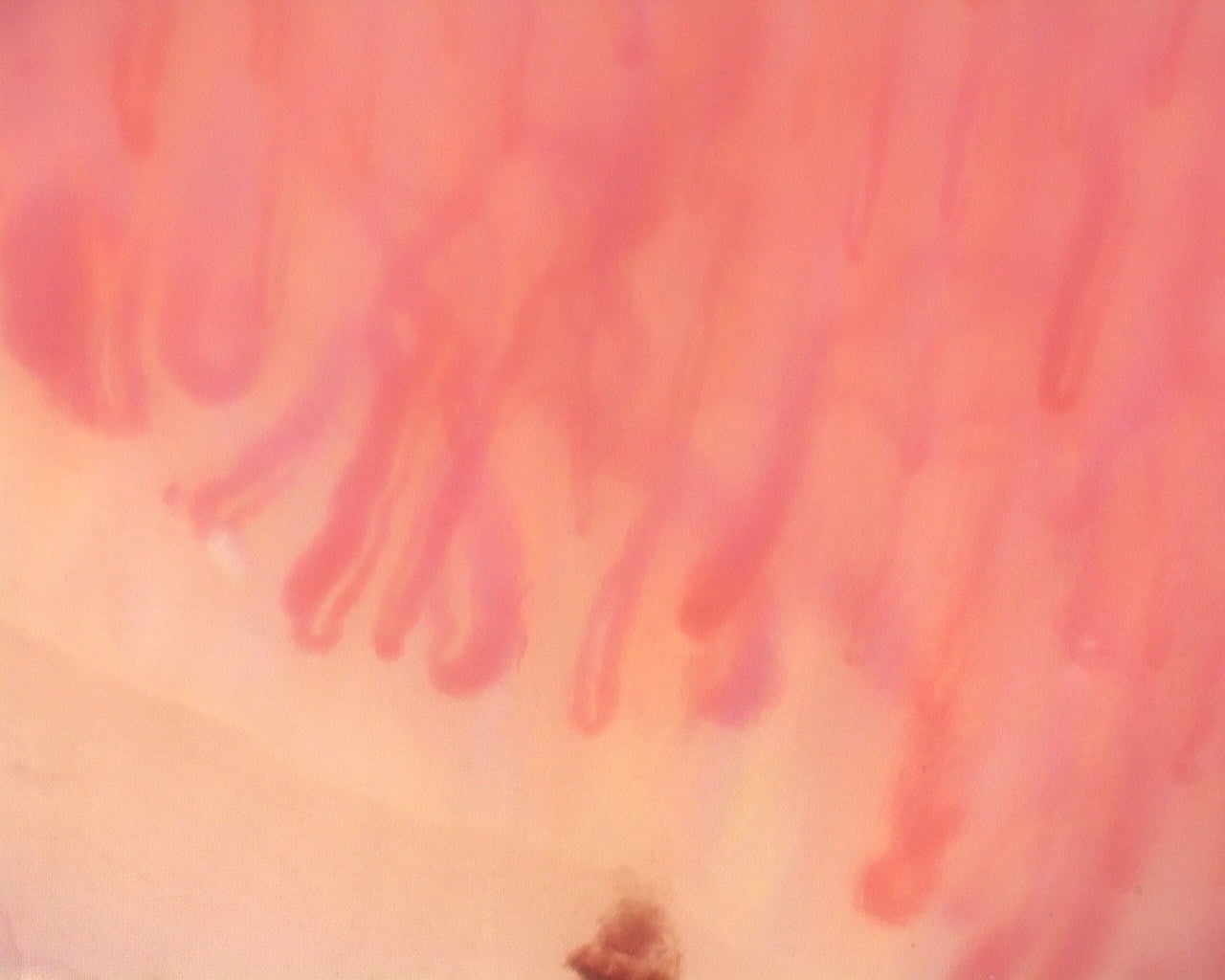 Nailfold capillaroscopy: left ring finger, field d. Diffuse Systemic Sclerosis (Anti-Scl-70+) with Active Cutolo Pattern.