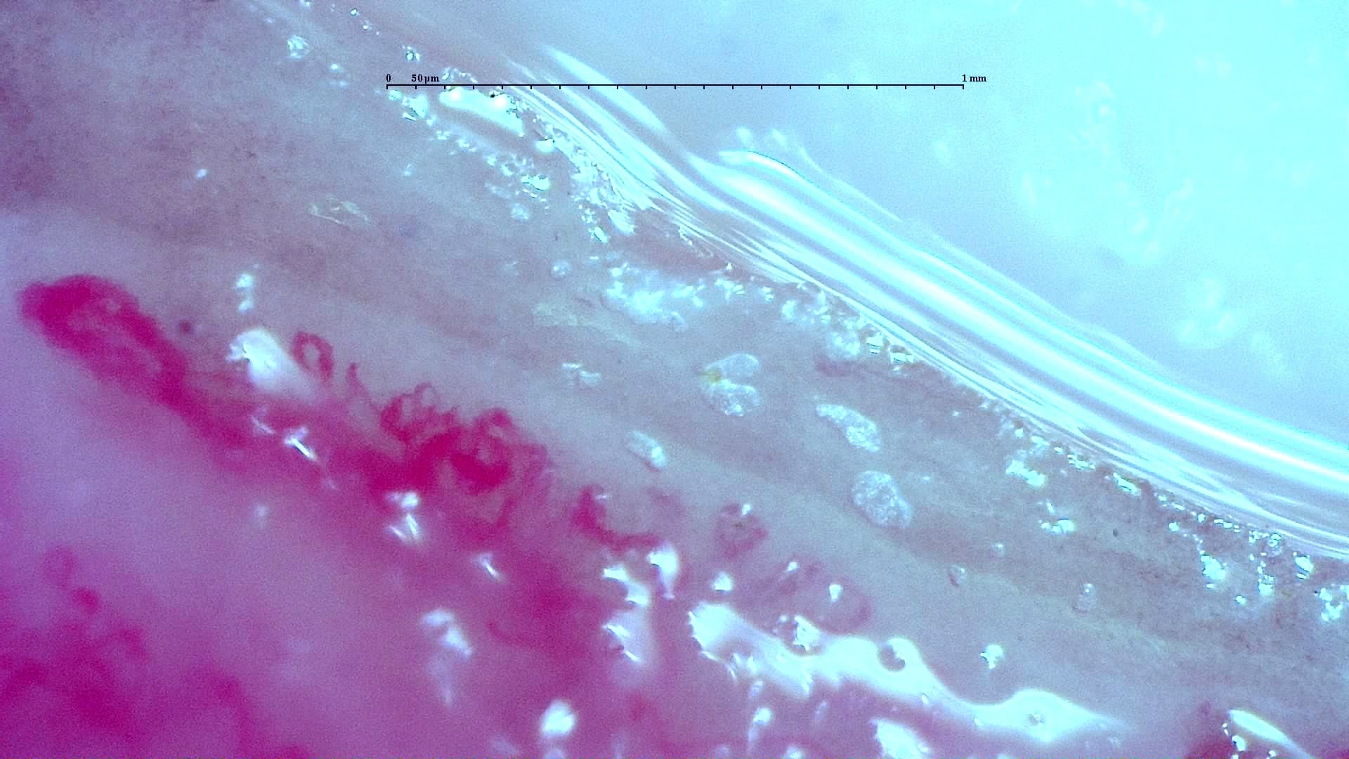Nailfold capillaroscopy: right ring finger, field c. Anti-TIF1γ Dermatomyositis with Scleroderma-Like Pattern.