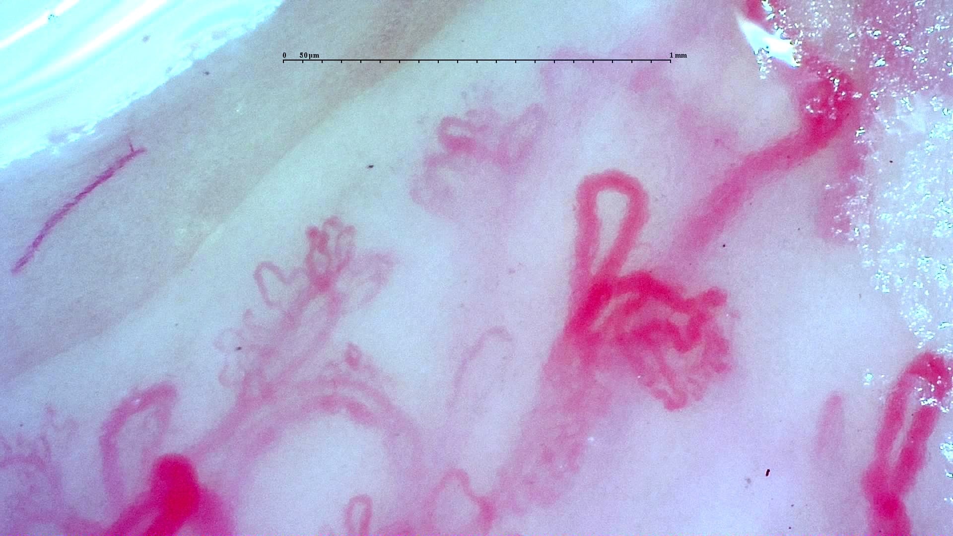 Nailfold capillaroscopy: left middle finger, field a. Anti-TIF1γ Dermatomyositis with Scleroderma-Like Pattern.