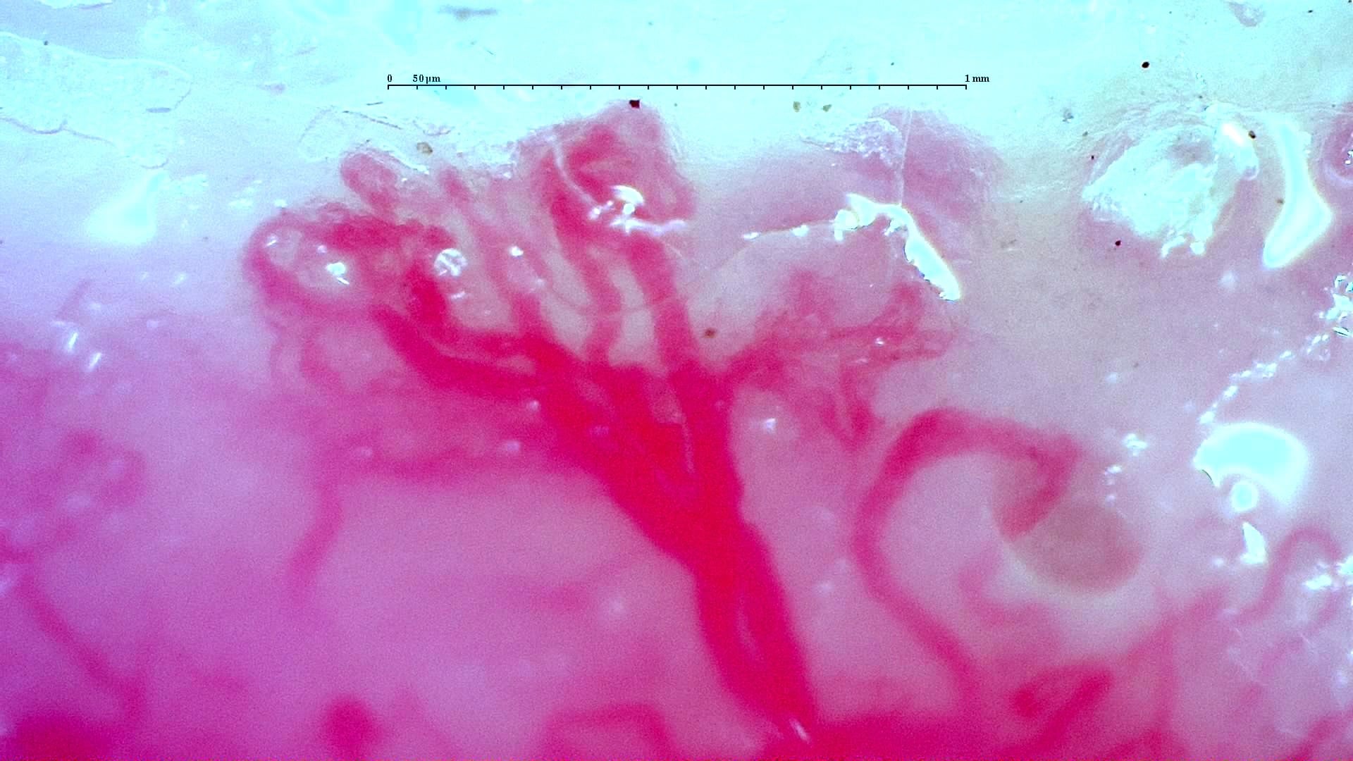 Nailfold capillaroscopy: right middle finger, field c. Anti-TIF1γ Dermatomyositis with Scleroderma-Like Pattern.
