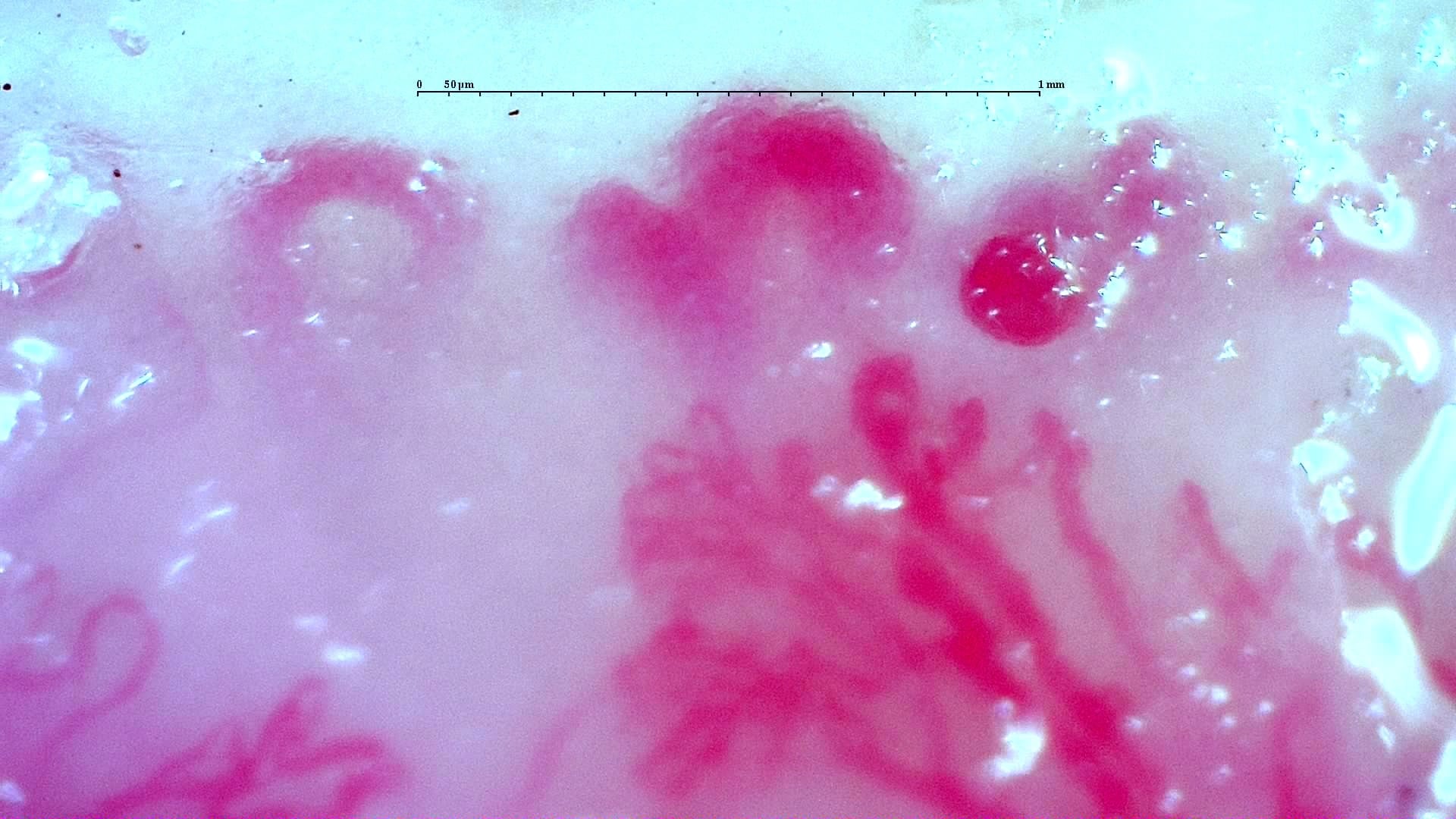 Nailfold capillaroscopy: right middle finger, field c. Anti-TIF1γ Dermatomyositis with Scleroderma-Like Pattern.