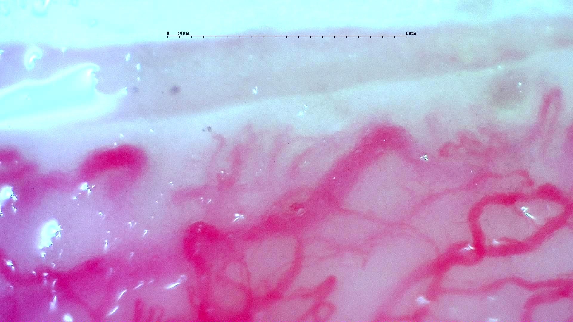 Nailfold capillaroscopy: left index finger, field c. Anti-TIF1γ Dermatomyositis with Scleroderma-Like Pattern.