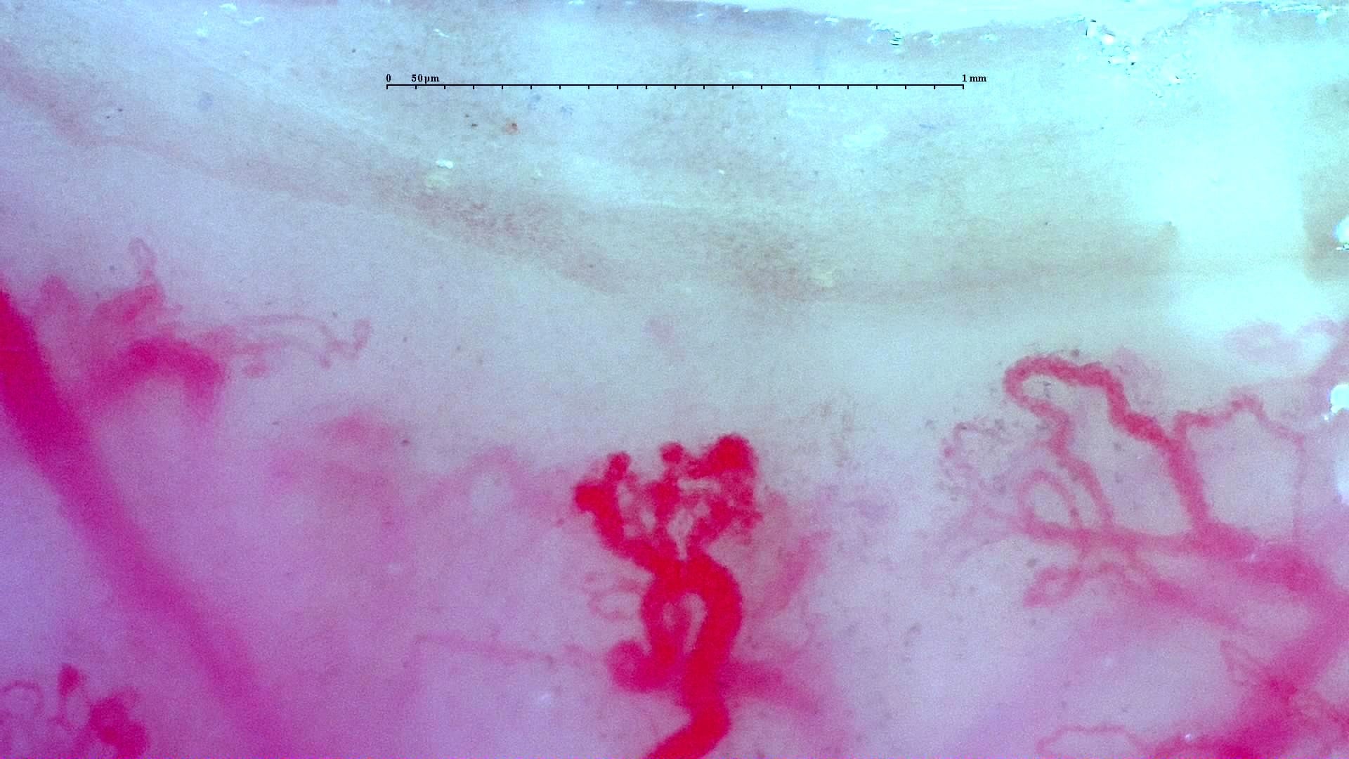 Nailfold capillaroscopy: left index finger, field c. Anti-TIF1γ Dermatomyositis with Scleroderma-Like Pattern.