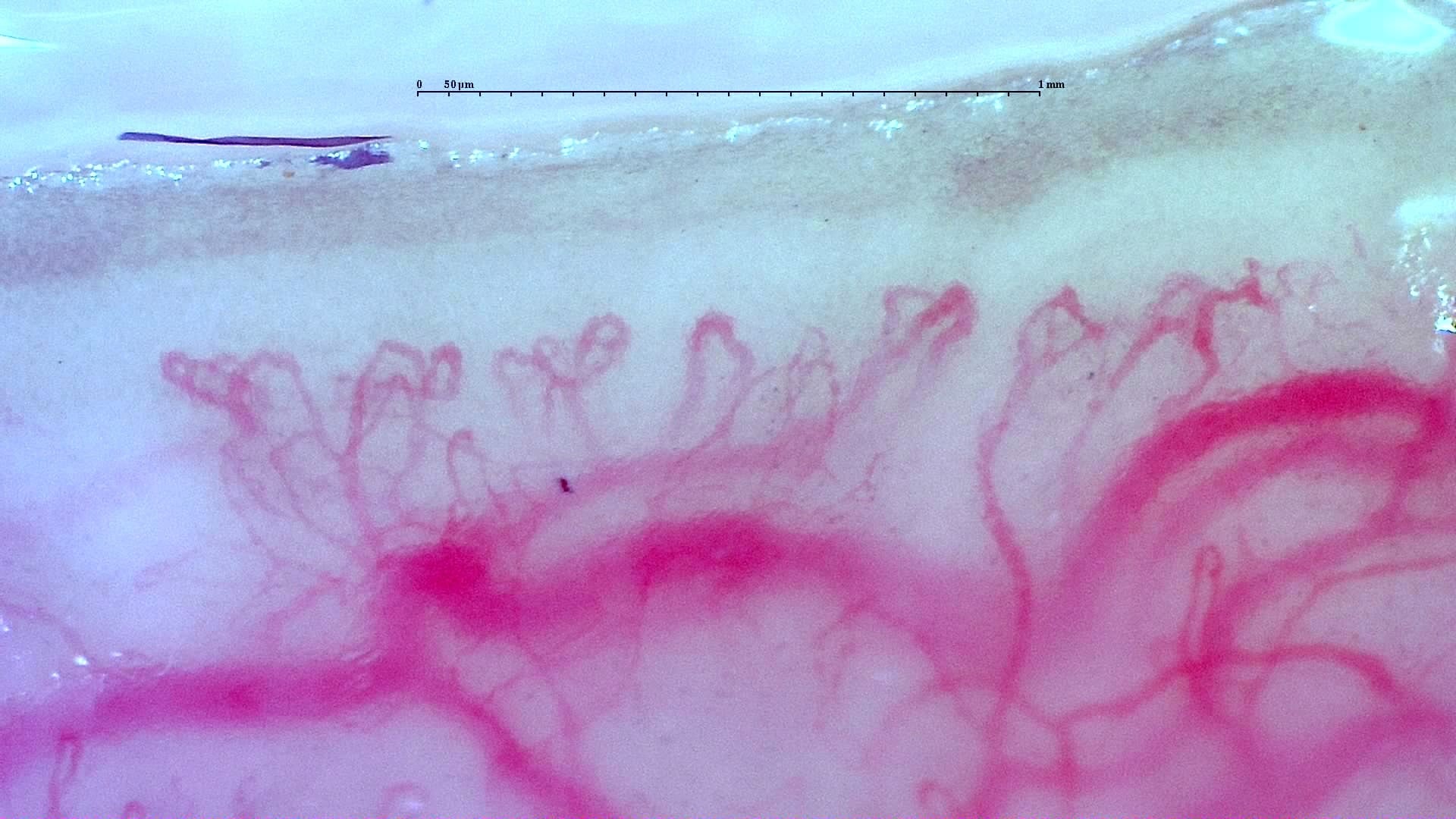 Nailfold capillaroscopy: right little finger, field a. Anti-TIF1γ Dermatomyositis with Scleroderma-Like Pattern.